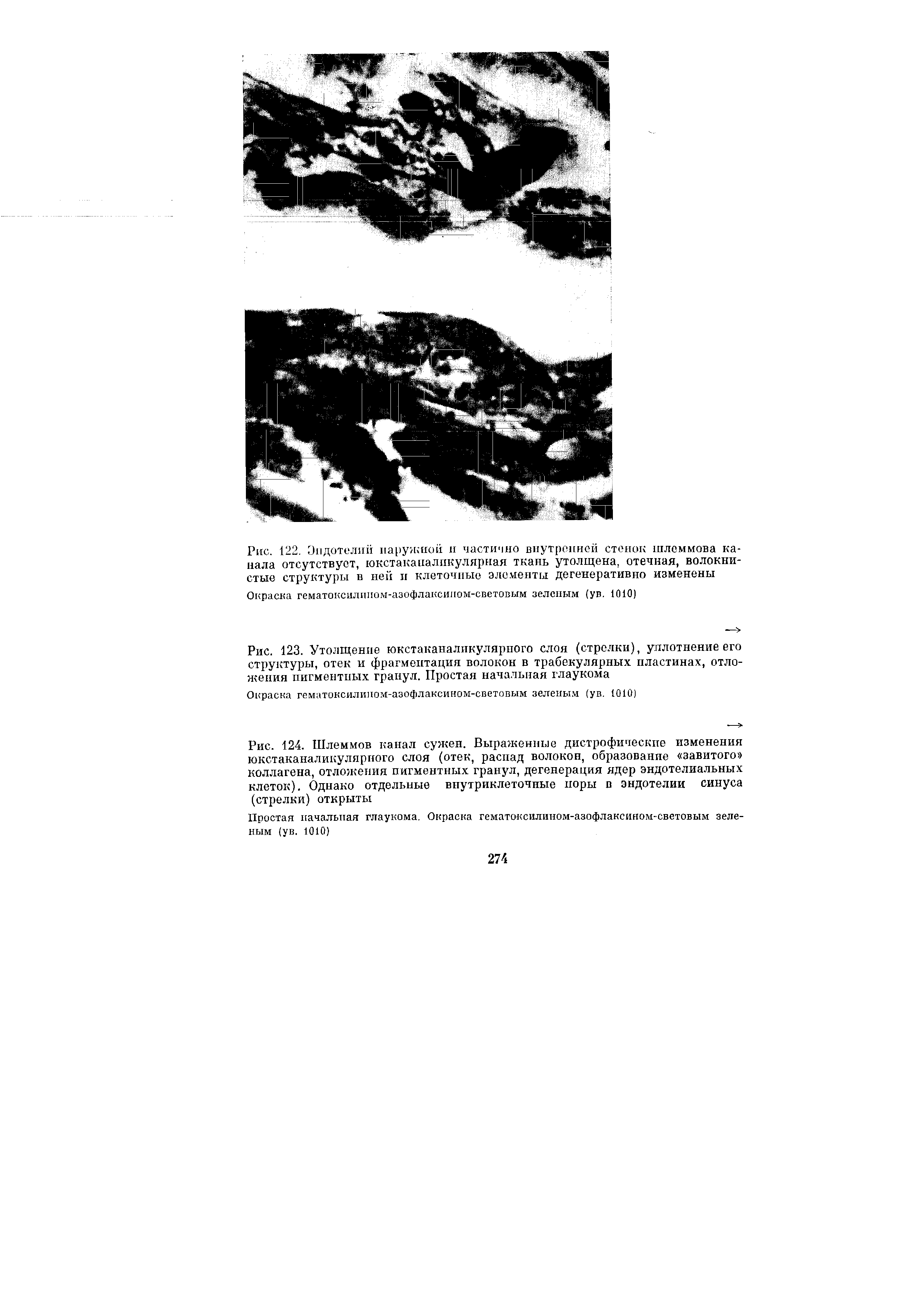 Рис. 123. Утолщение юкстаканаликулярного слоя (стрелки), уплотнение его структуры, отек и фрагментация волокон в трабекулярных пластинах, отложения пигментных гранул. Простая начальная глаукома...