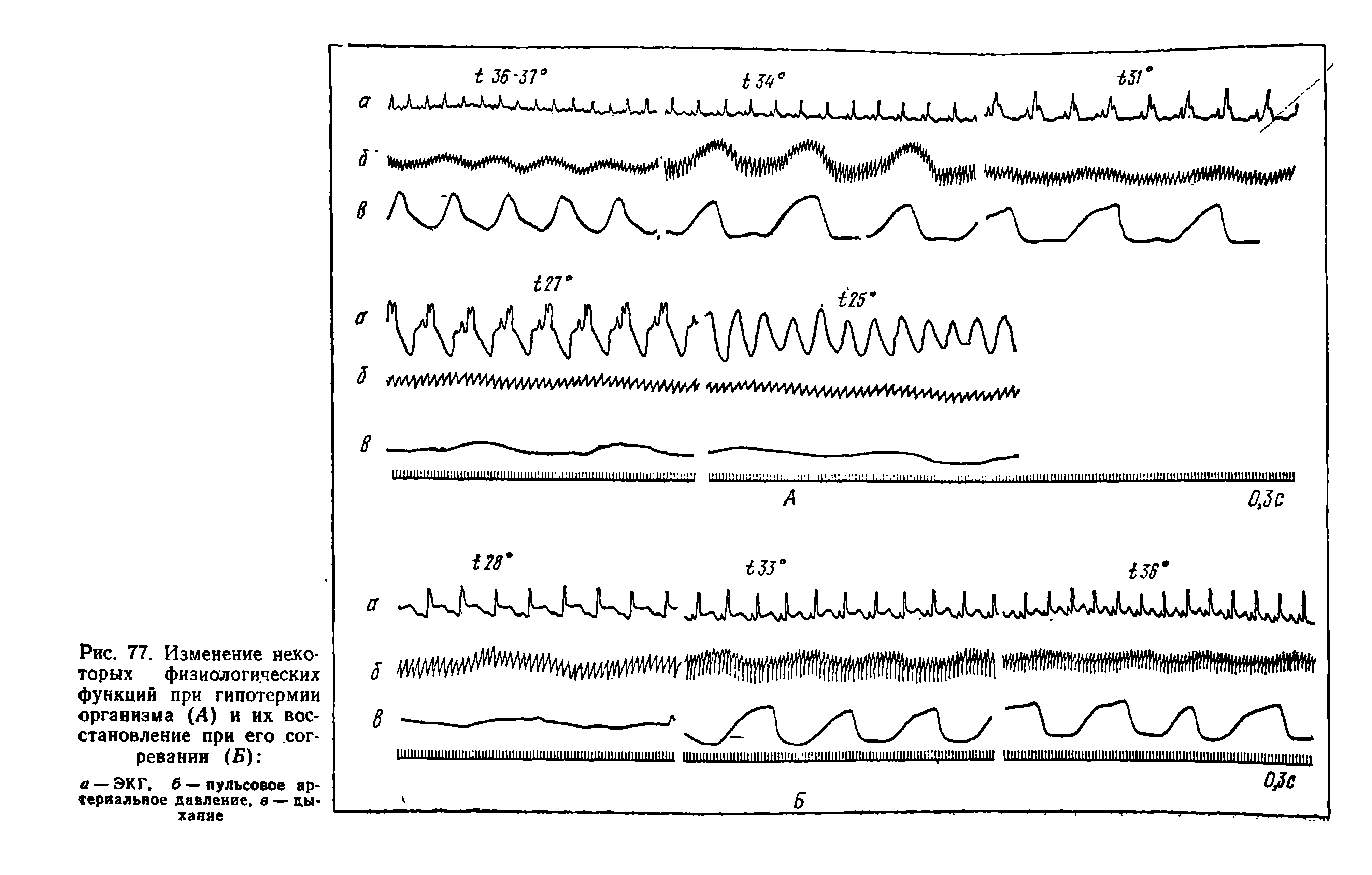 Рис. 77. Изменение некоторых физиологических функций при гипотермии организма (А) и их восстановление при его согревании (Б) ...