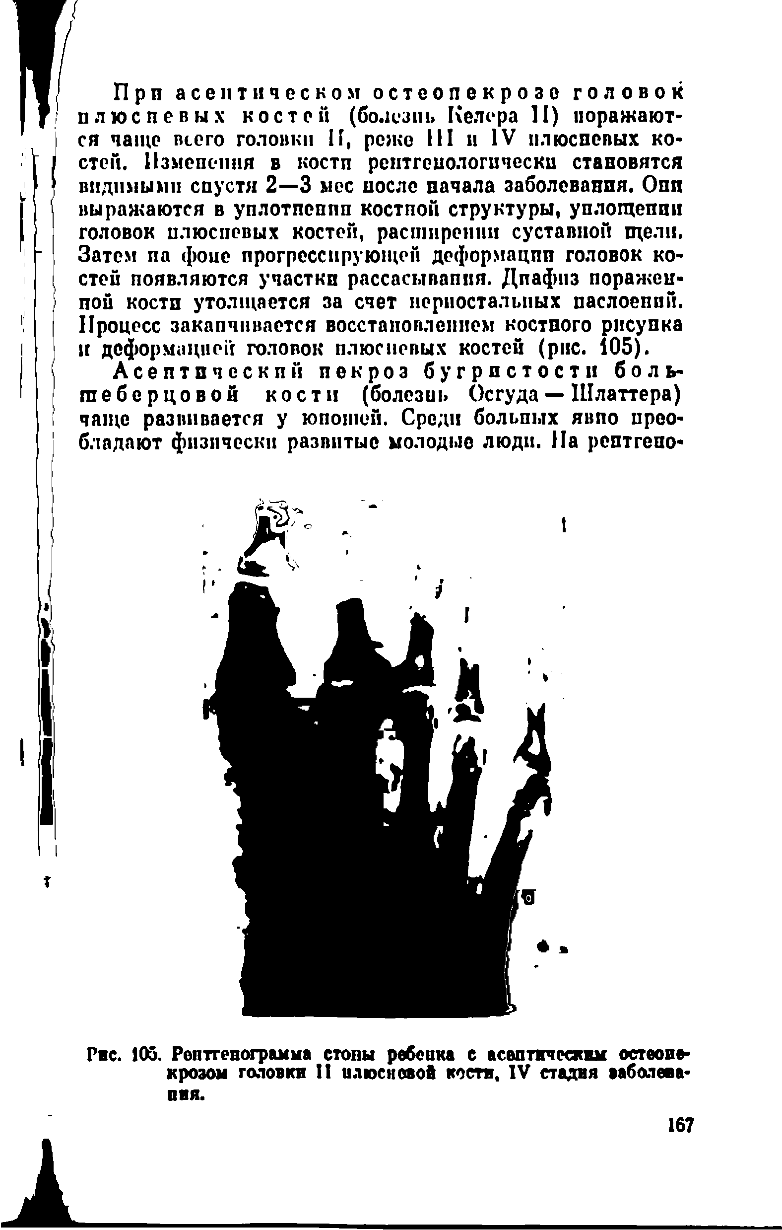 Рис. 105. Рептгепогршма стопы ребеика с асептически остеонекрозом головки II илюсновой кости, IV стадия заболевания.