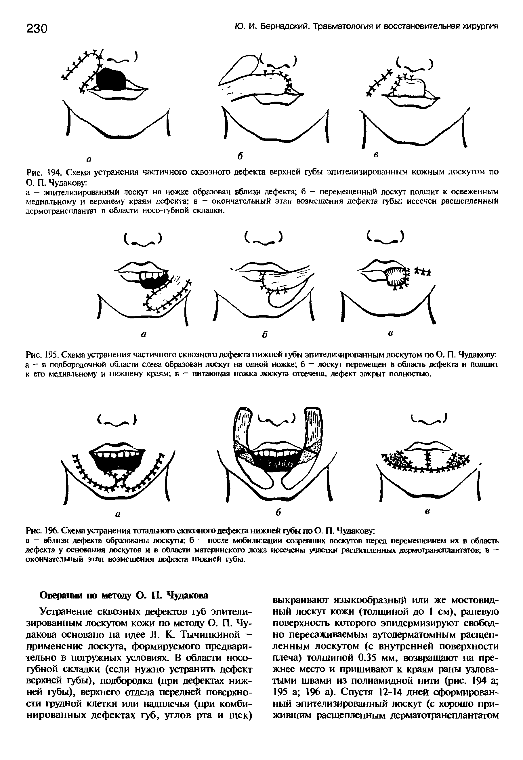 Рис. 194. Схема устранения частичного сквозного дефекта верхней губы эпителизированным кожным лоскутом по О. П. Чудакову ...