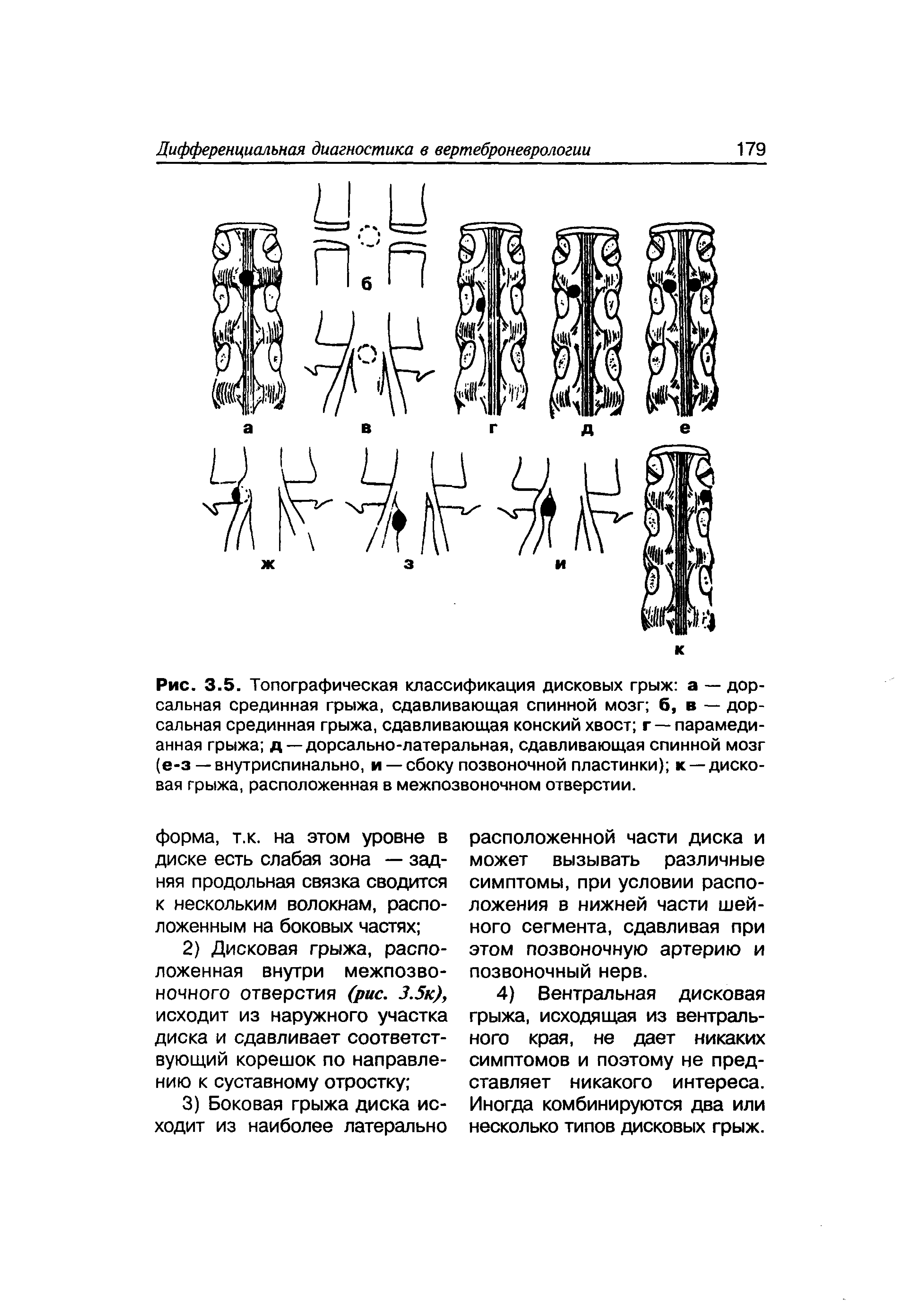 Рис. 3-5. Топографическая классификация дисковых грыж а — дорсальная срединная грыжа, сдавливающая спинной мозг б, в — дорсальная срединная грыжа, сдавливающая конский хвост г —парамедианная грыжа д — дорсально-латеральная, сдавливающая спинной мозг (е-з — внутриспинально, и —сбоку позвоночной пластинки) к —дисковая грыжа, расположенная в межпозвоночном отверстии.