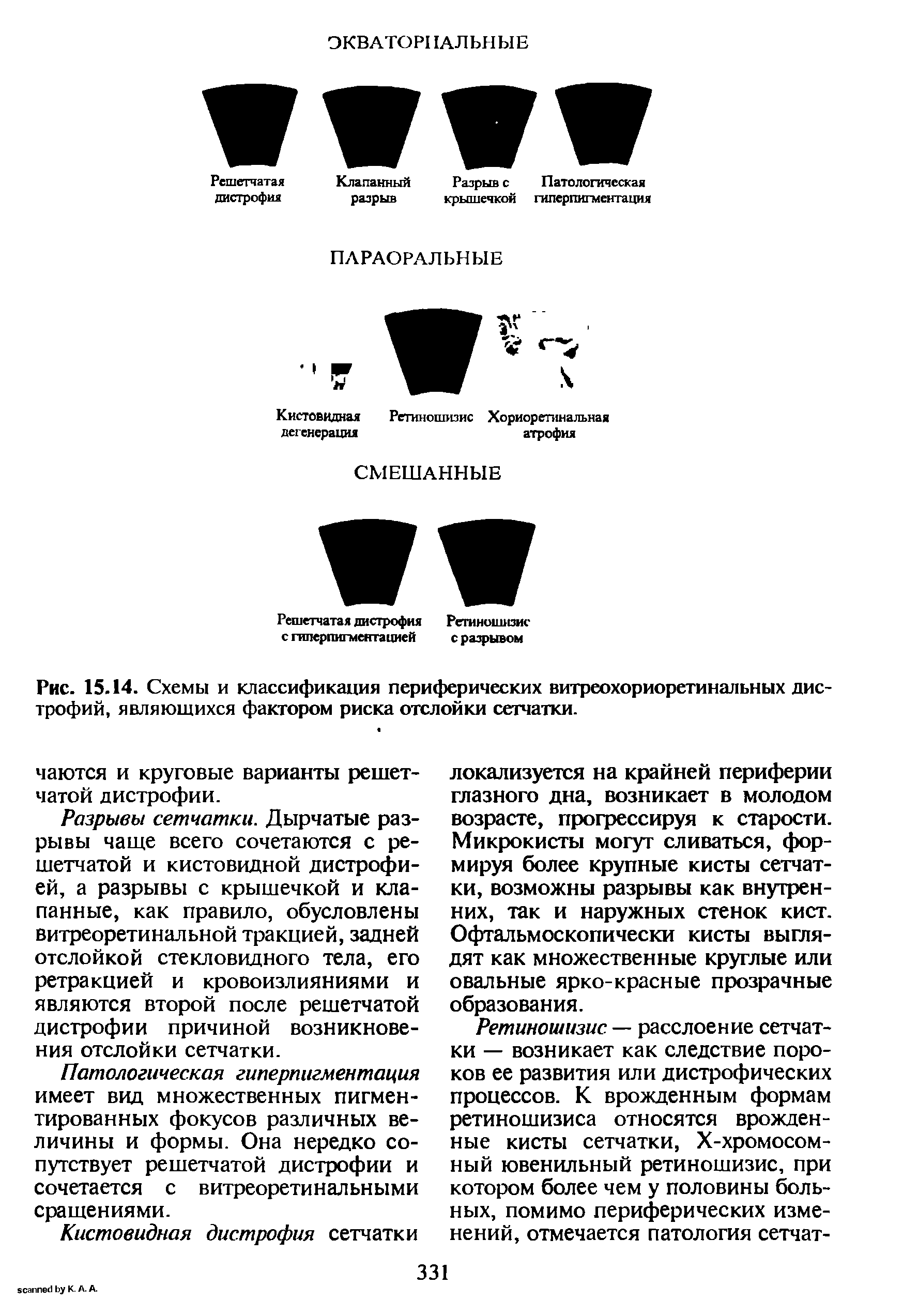 Рис. 15.14. Схемы и классификация периферических витреохориоретинальных дистрофий, являющихся фактором риска отслойки сетчатки.