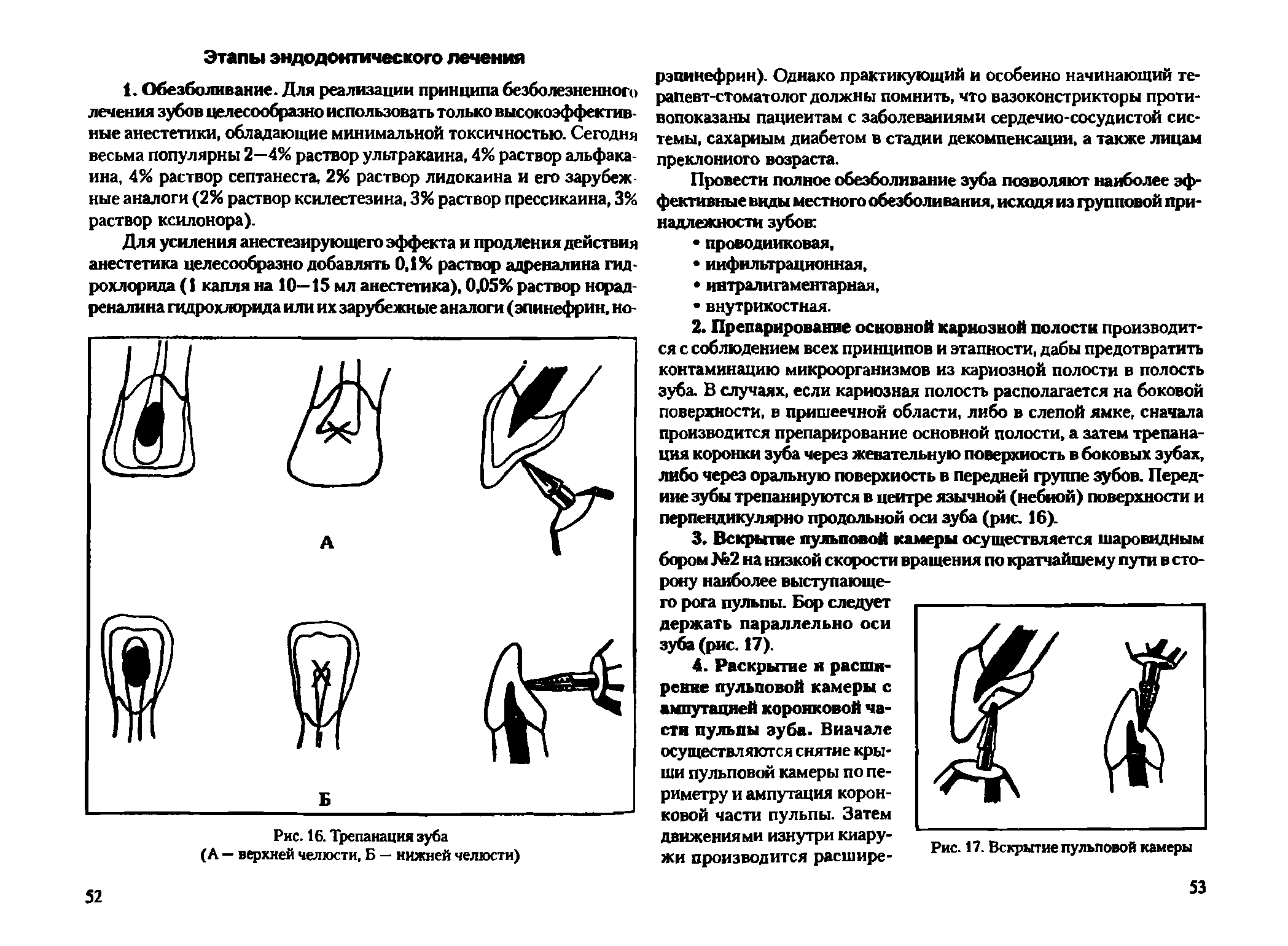 Рис. 16. Трепанация зуба (А — верхней челюсти, Б — нижней челюсти)...