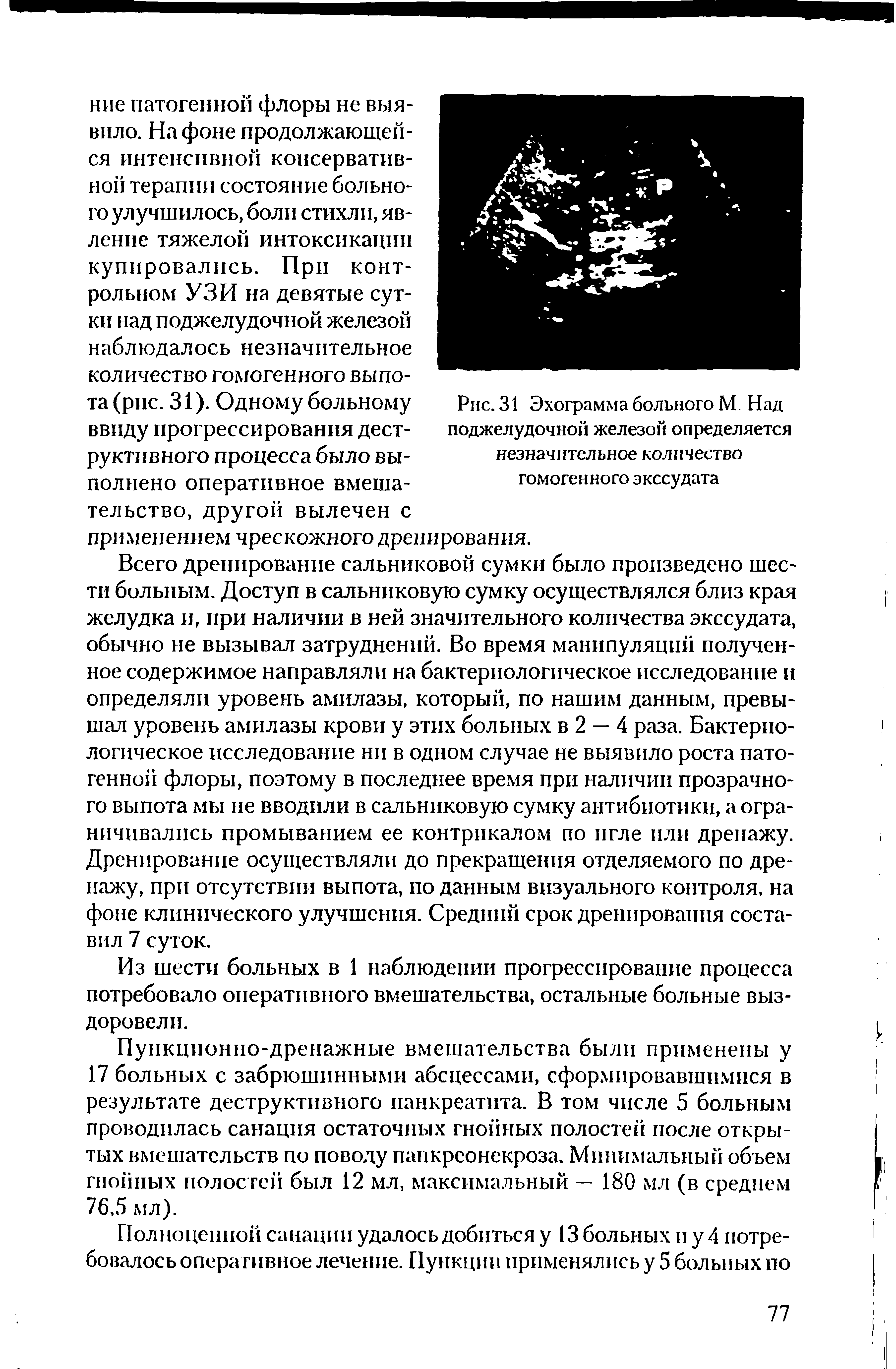 Рис. 31 Эхограмма больного М. Над поджелудочной железой определяется незначительное количество гомогенного экссудата...