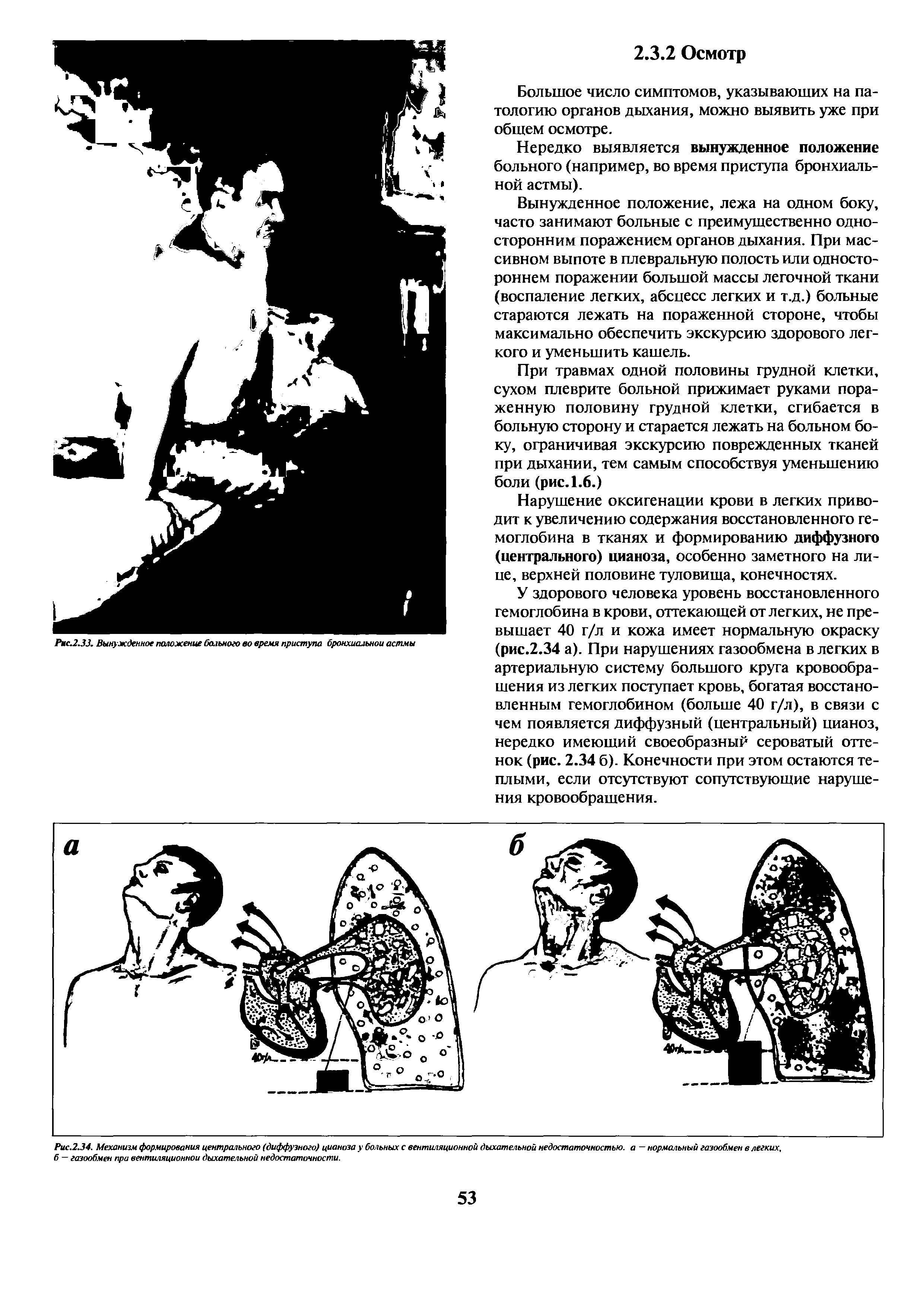 Рис.2.34. Механизм формирования центрального (диффузного) цианоза у больных с вентиляционной дыхательной недостаточностью, а — нормальный газообмен в легких, б — газообмен при вентиляционной дыхательной недостаточности.