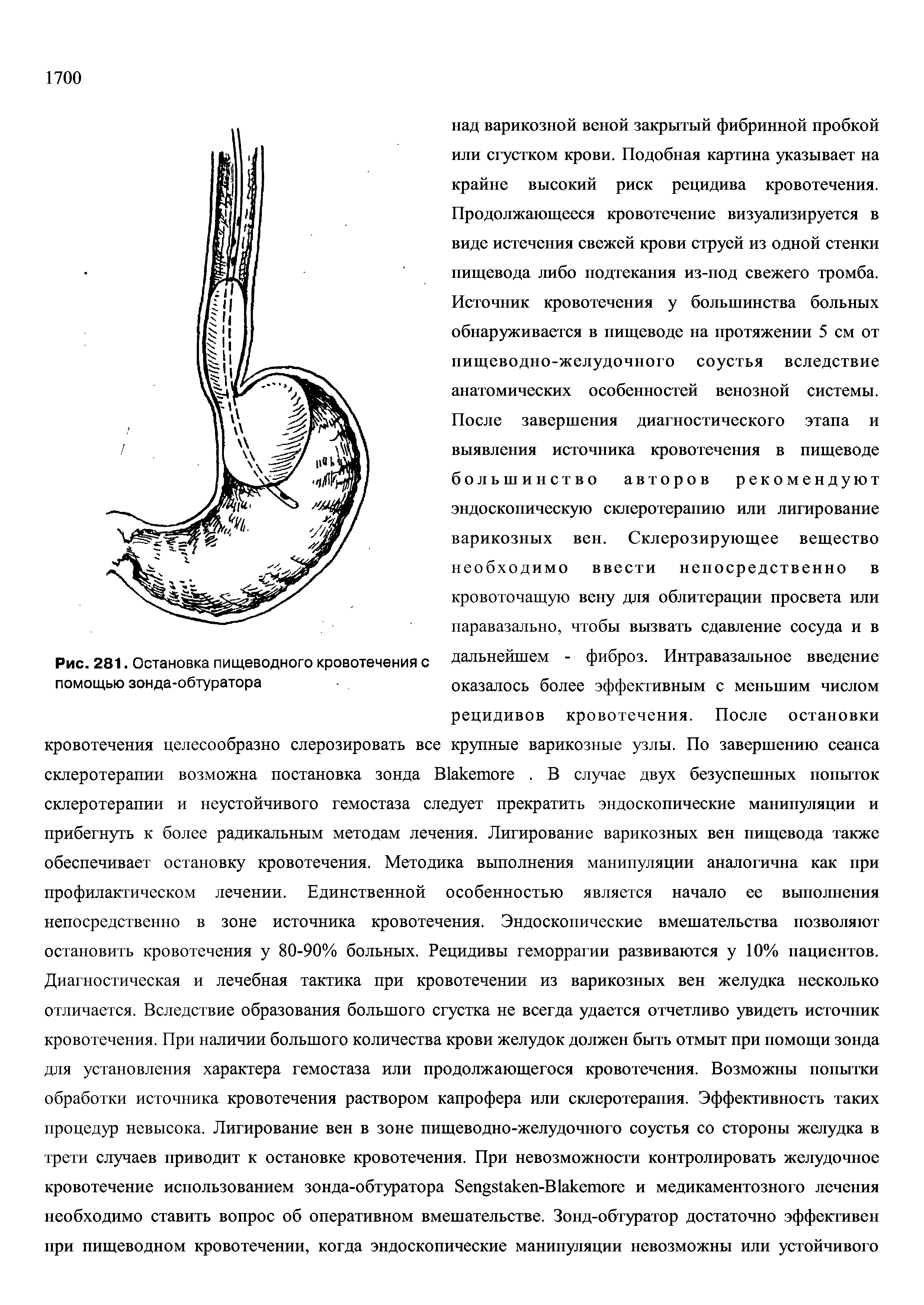 Рис. 281. Остановка пищеводного кровотечения с помощью зонда-обтуратора...