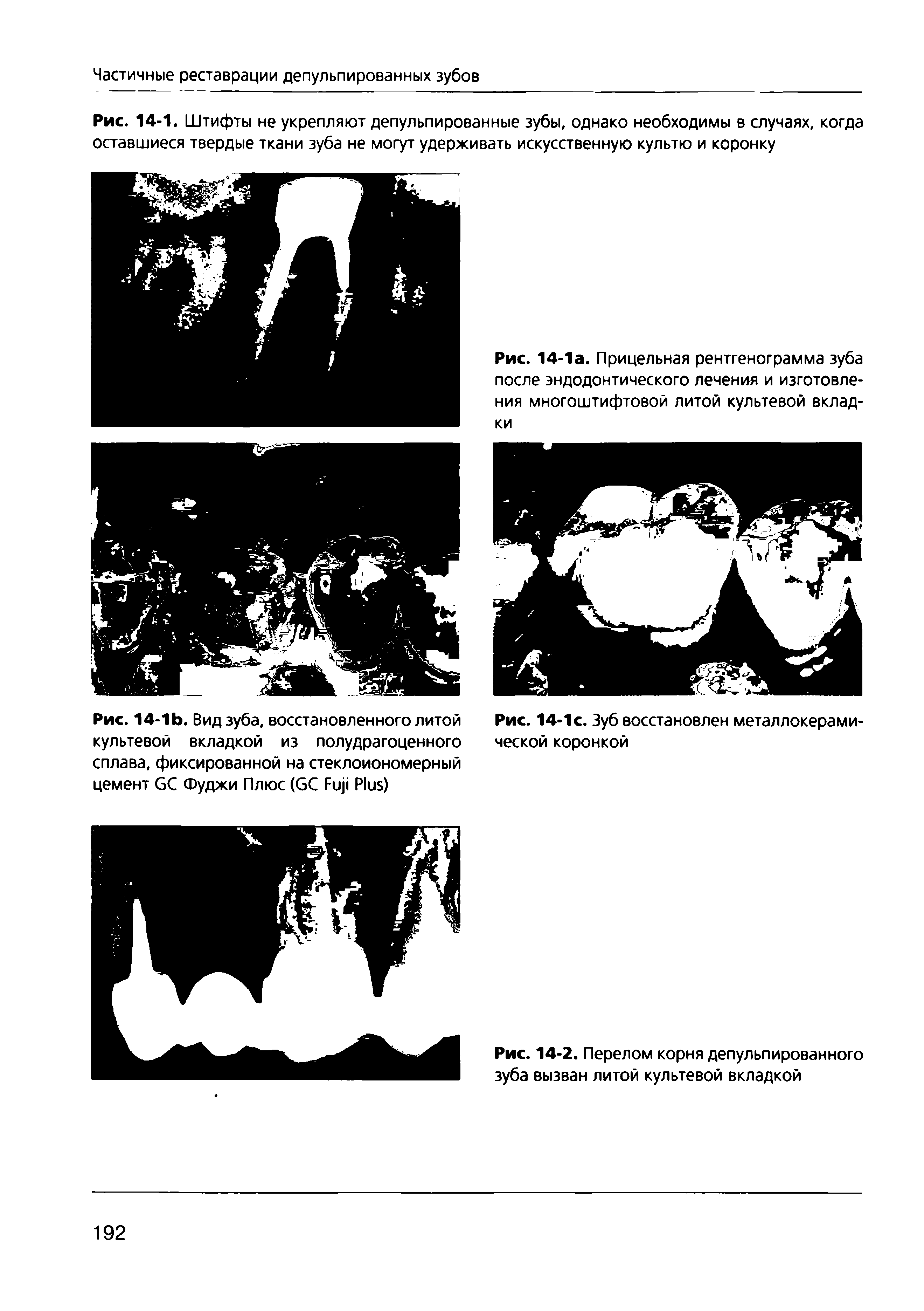 Рис. 14-1. Штифты не укрепляют депульпированные зубы, однако необходимы в случаях, когда оставшиеся твердые ткани зуба не могут удерживать искусственную культю и коронку...