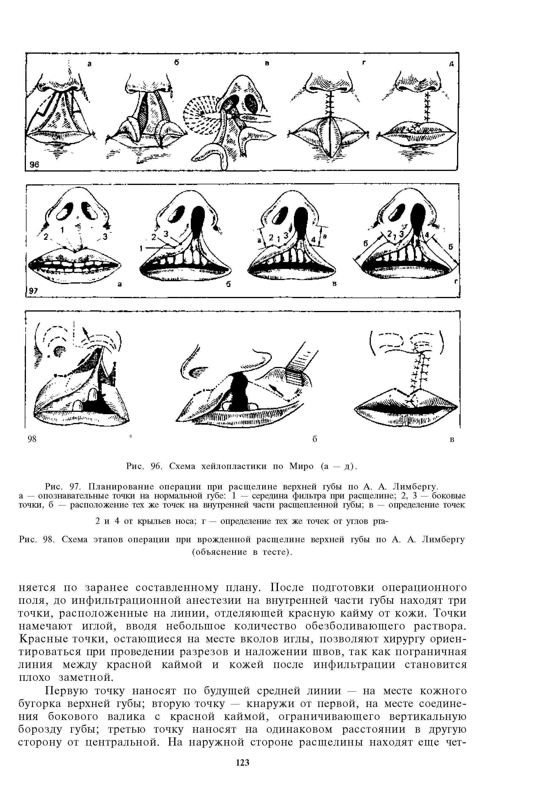 Рис. 97. Планирование операции при расщелине верхней губы по А. А. Лимбергу. а — опознавательные точки на нормальной губе 1 — середина фильтра при расщелине 2, 3 — боковые точки, б — расположение тех же точек на внутренней части расщепленной губы в — определение точек...