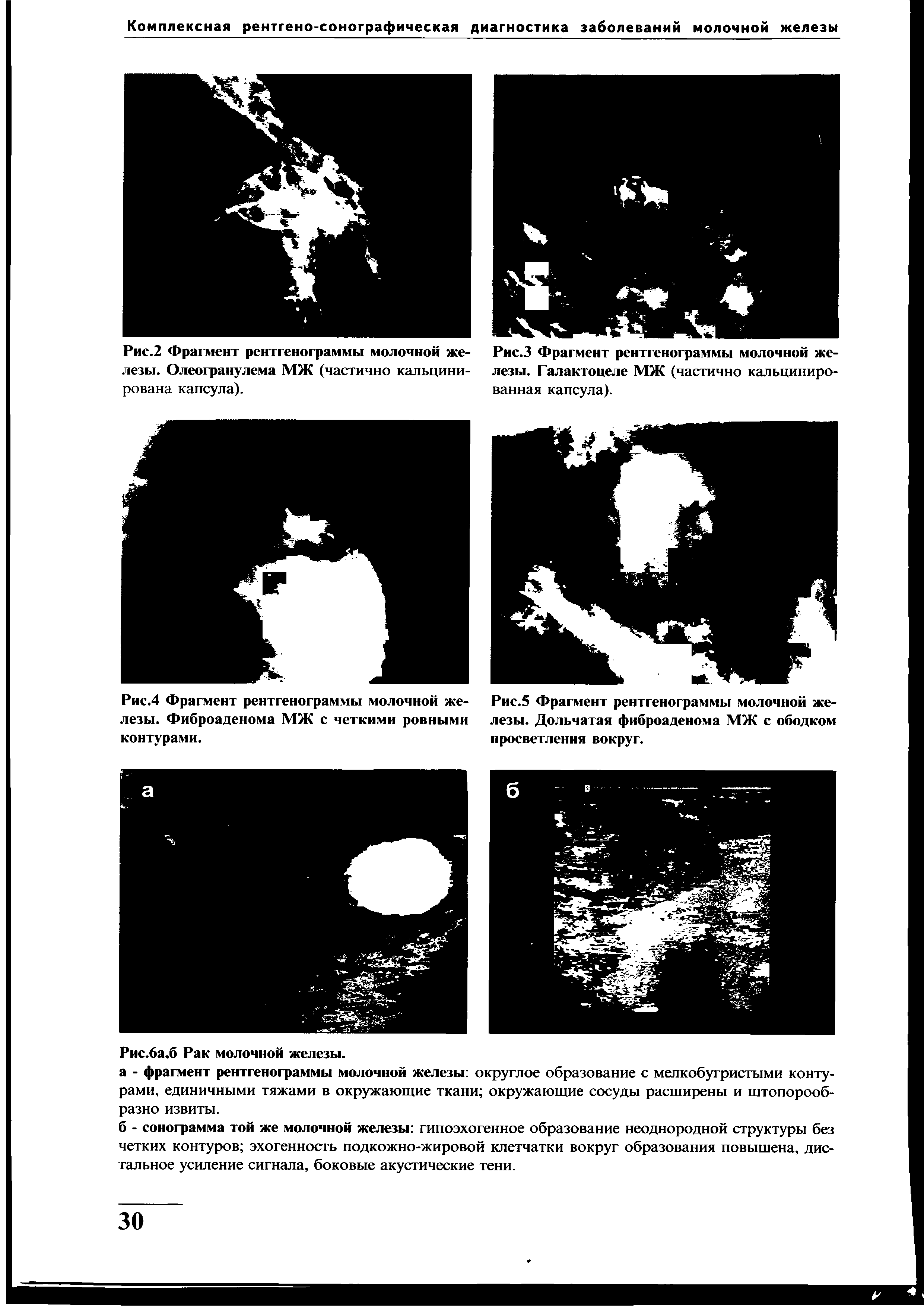 Рис.4 Фрагмент рентгенограммы молочной железы. Фиброаденома МЖ с четкими ровными контурами.