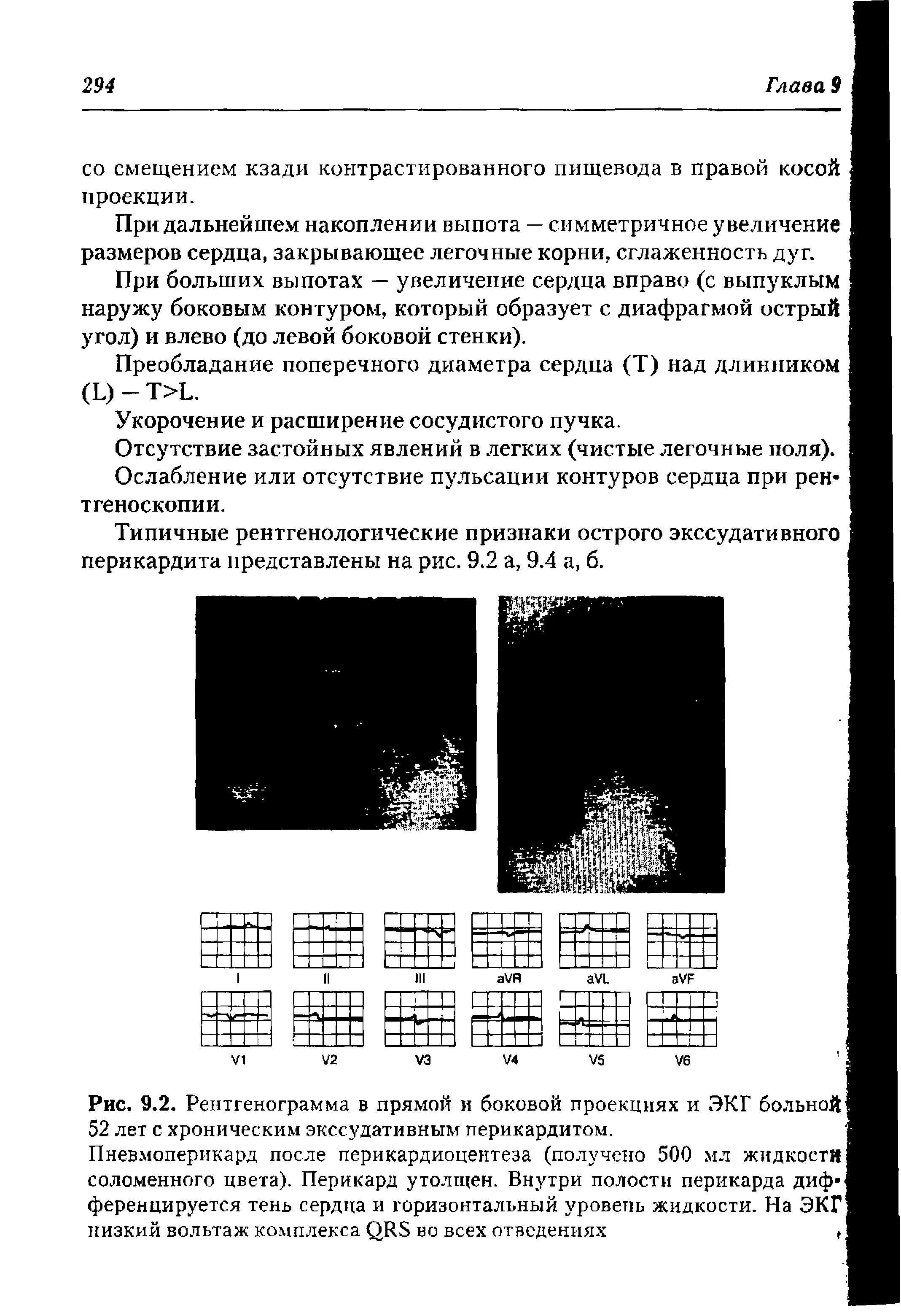 Рис. 9.2. Рентгенограмма в прямой и боковой проекциях и ЭКГ больной 52 лет с хроническим экссудативным перикардитом.