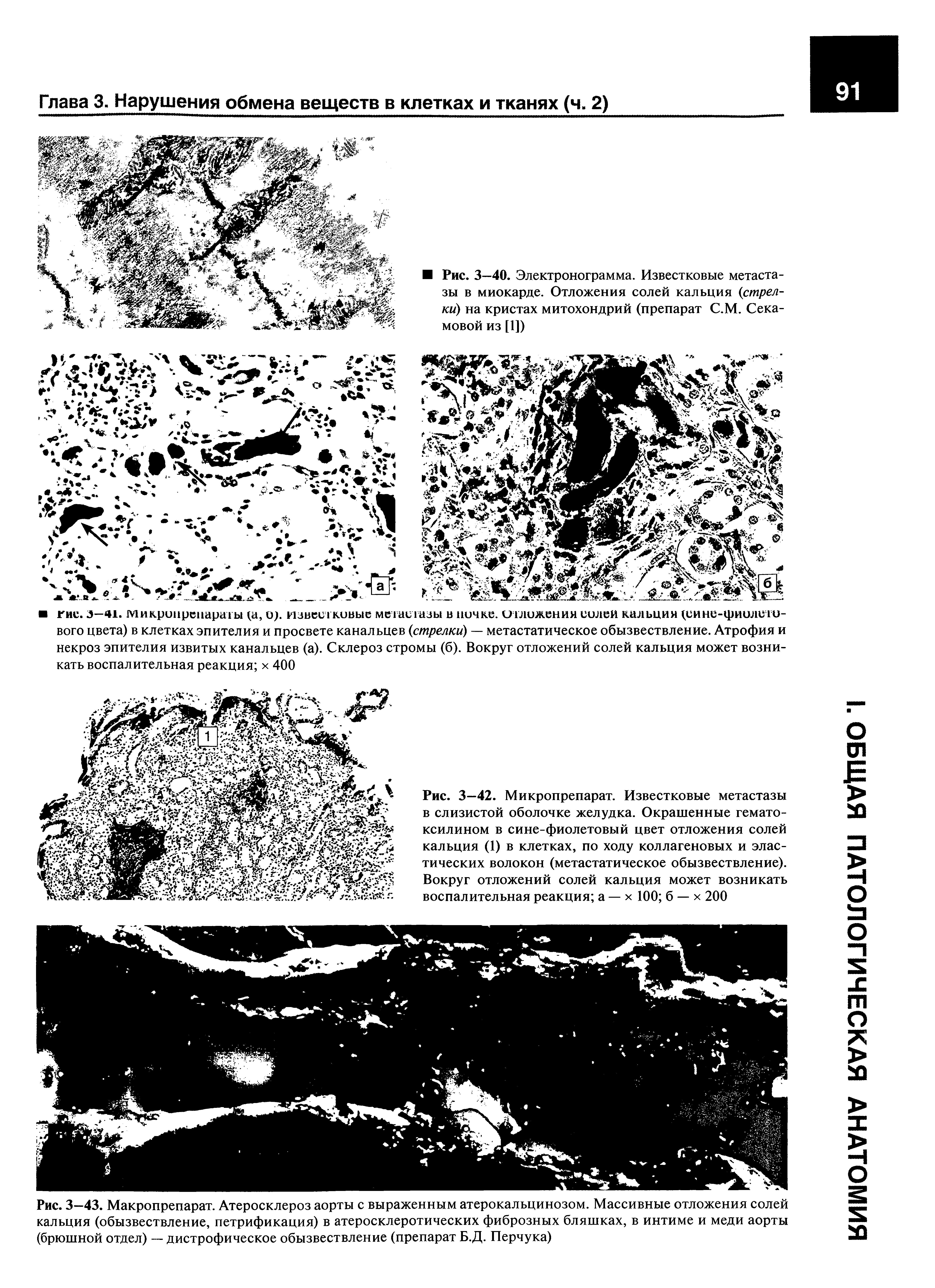 Рис. 3—42. Микропрепарат. Известковые метастазы в слизистой оболочке желудка. Окрашенные гематоксилином в сине-фиолетовый цвет отложения солей кальция (1) в клетках, по ходу коллагеновых и эластических волокон (метастатическое обызвествление). Вокруг отложений солей кальция может возникать воспалительная реакция а — х 100 б — х 200...