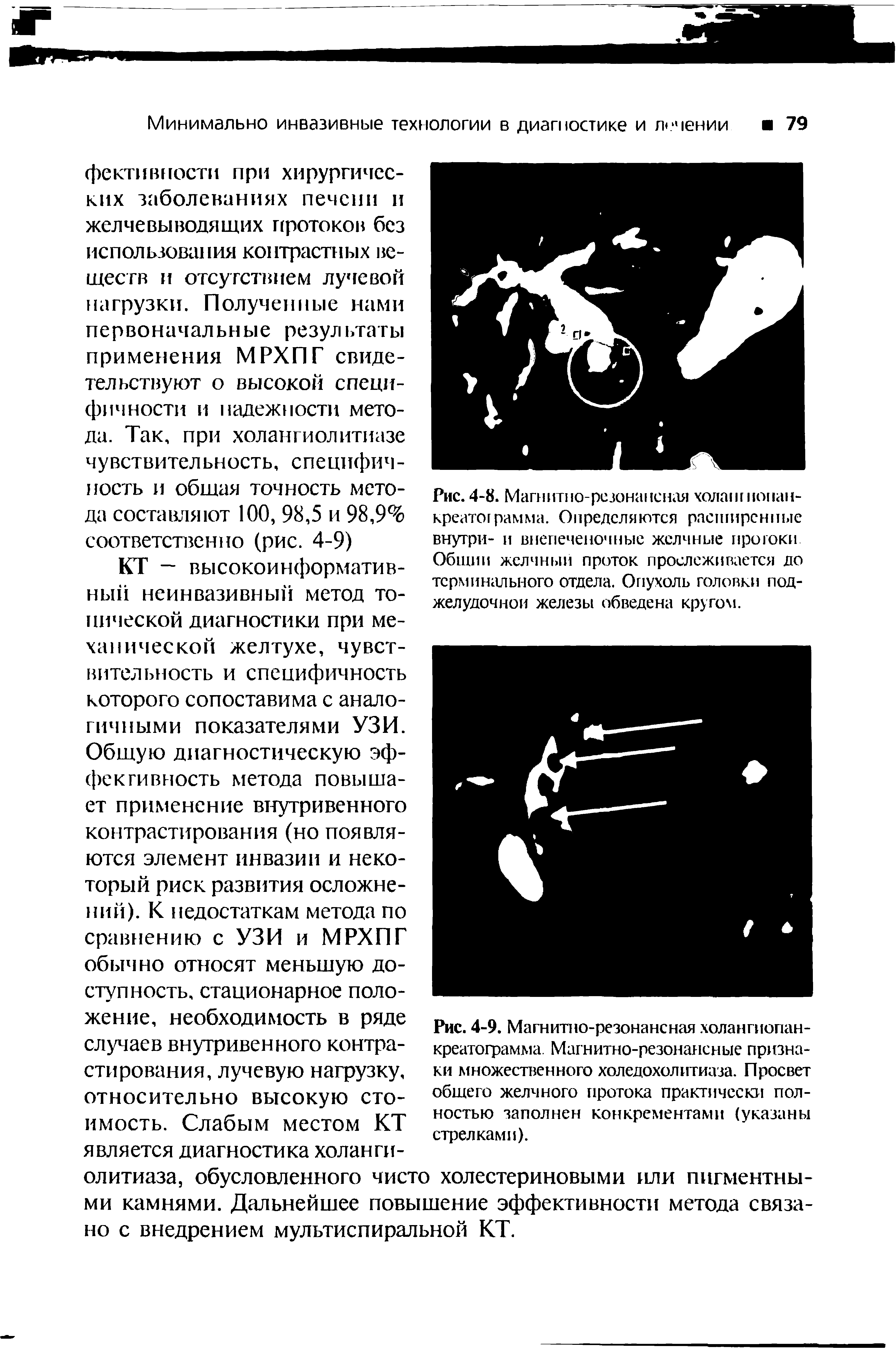 Рис. 4-8. Магнитно-резонансная коланг нонан-креатог рамма. Определяются расширенные внутри- и внепеченочные желчные протоки Общин желчный проток прослеживается до терминального отдела. Опухоль голоики поджелудочной железы обведена кругом.