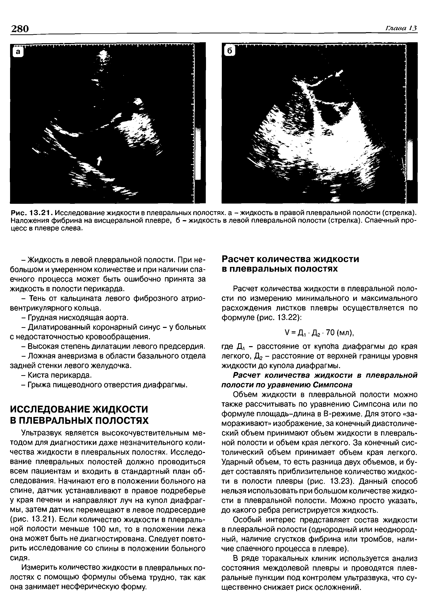 Рис. 13.21. Исследование жидкости в плевральных полостях, а - жидкость в правой плевральной полости (стрелка). Наложения фибрина на висцеральной плевре, б - жидкость в левой плевральной полости (стрелка). Спаечный процесс в плевре слева.