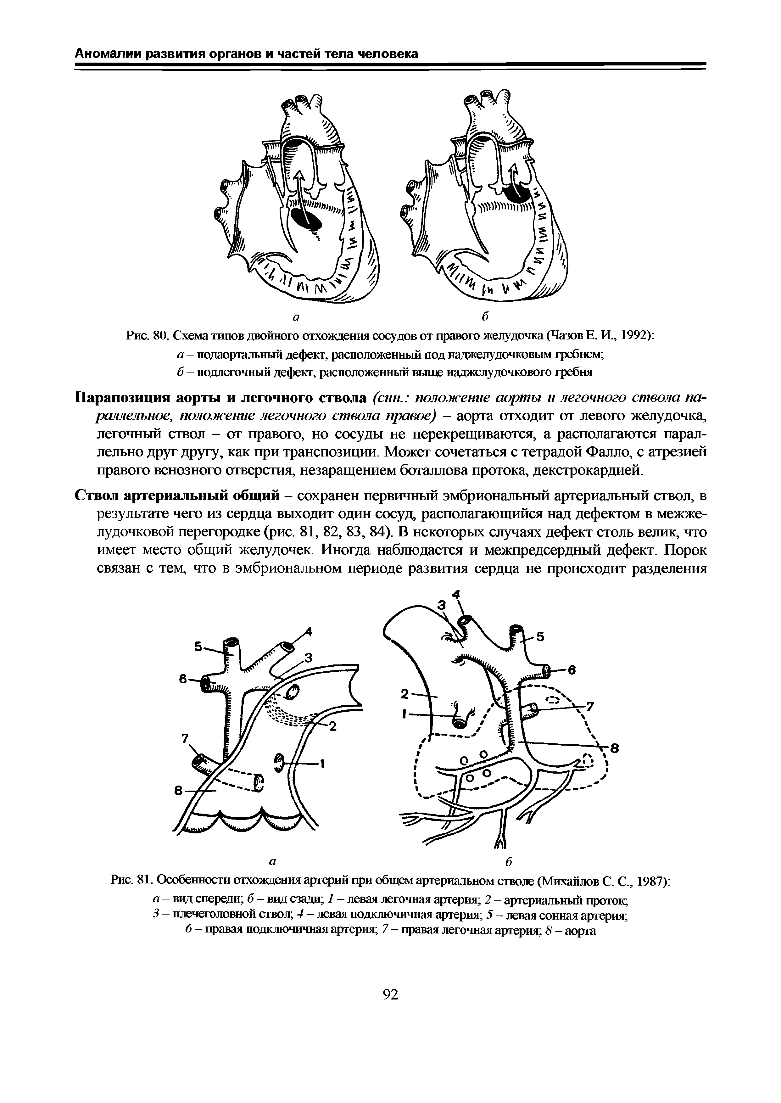 Рис. 80. Схема типов двойного отхождения сосудов от правого желудочка (Чазов Е. И., 1992) а - подаортальный дефект, расположенный под наджелудочковым гребнем ...