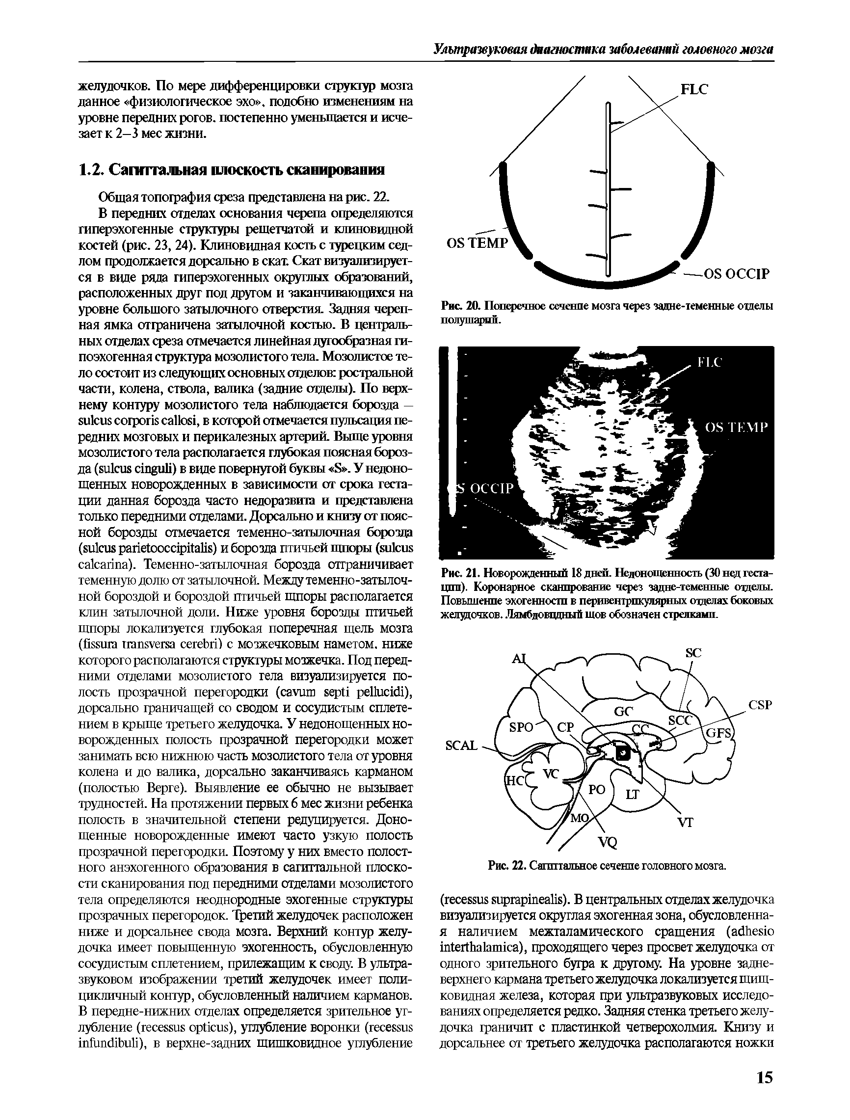 Рис. 21. Новорожденный 18 дней. Недоношенность (30 нед гестации). Коронарное сканирование через задне-теменные отделы. Повышение эхогенности в перивентрпкулярных отделах боковых желудочков. Лямбдовидный шов обозначен стрелками.