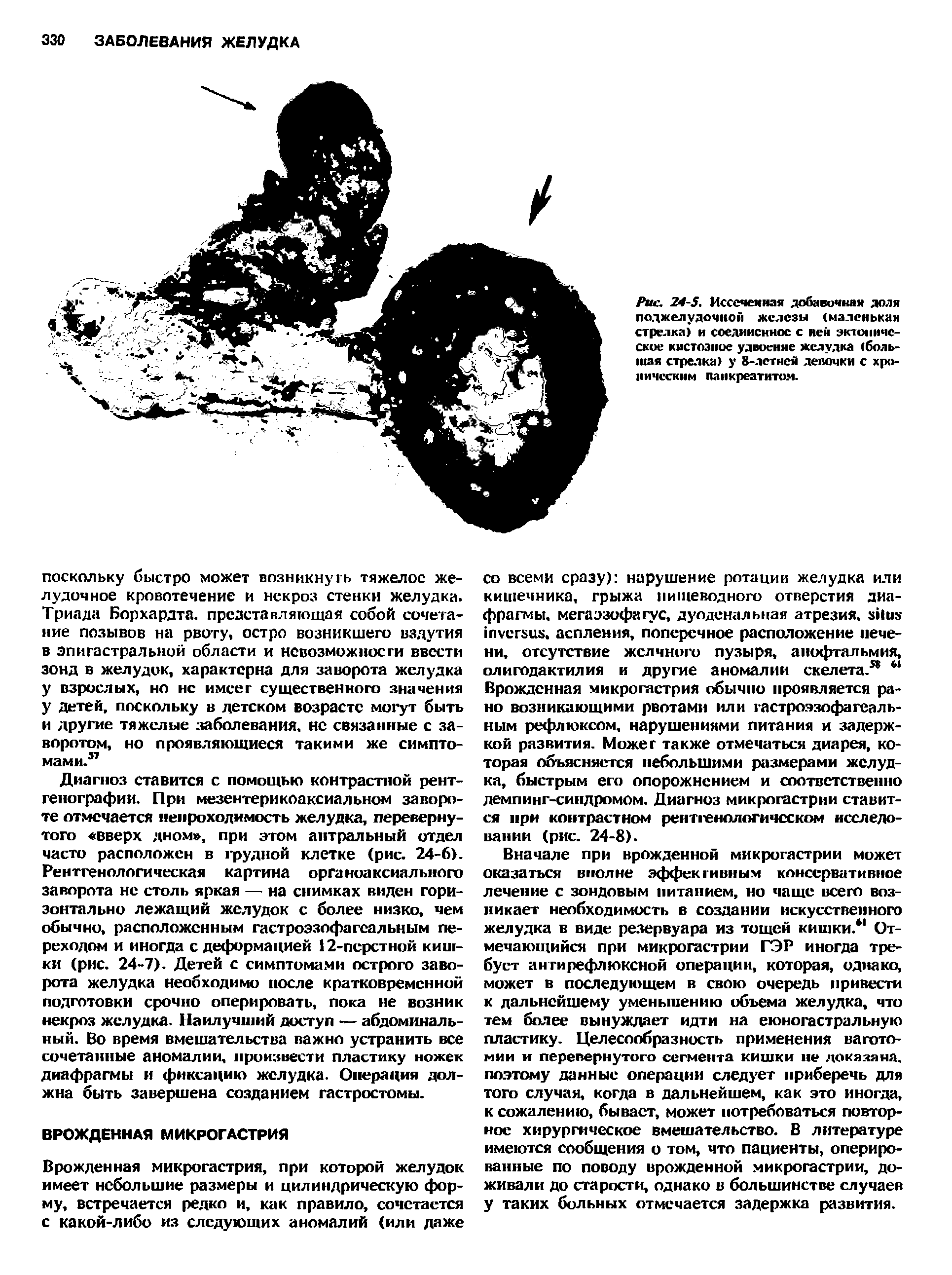 Рис. 24-5. Иссеченная добавочная доля поджелудочной железы (маленькая стрелка) и соединенное с ней эктопическое кистозное удвоение желудка (большая стрелка) у 8-летней депочки с хроническим панкреатитом.