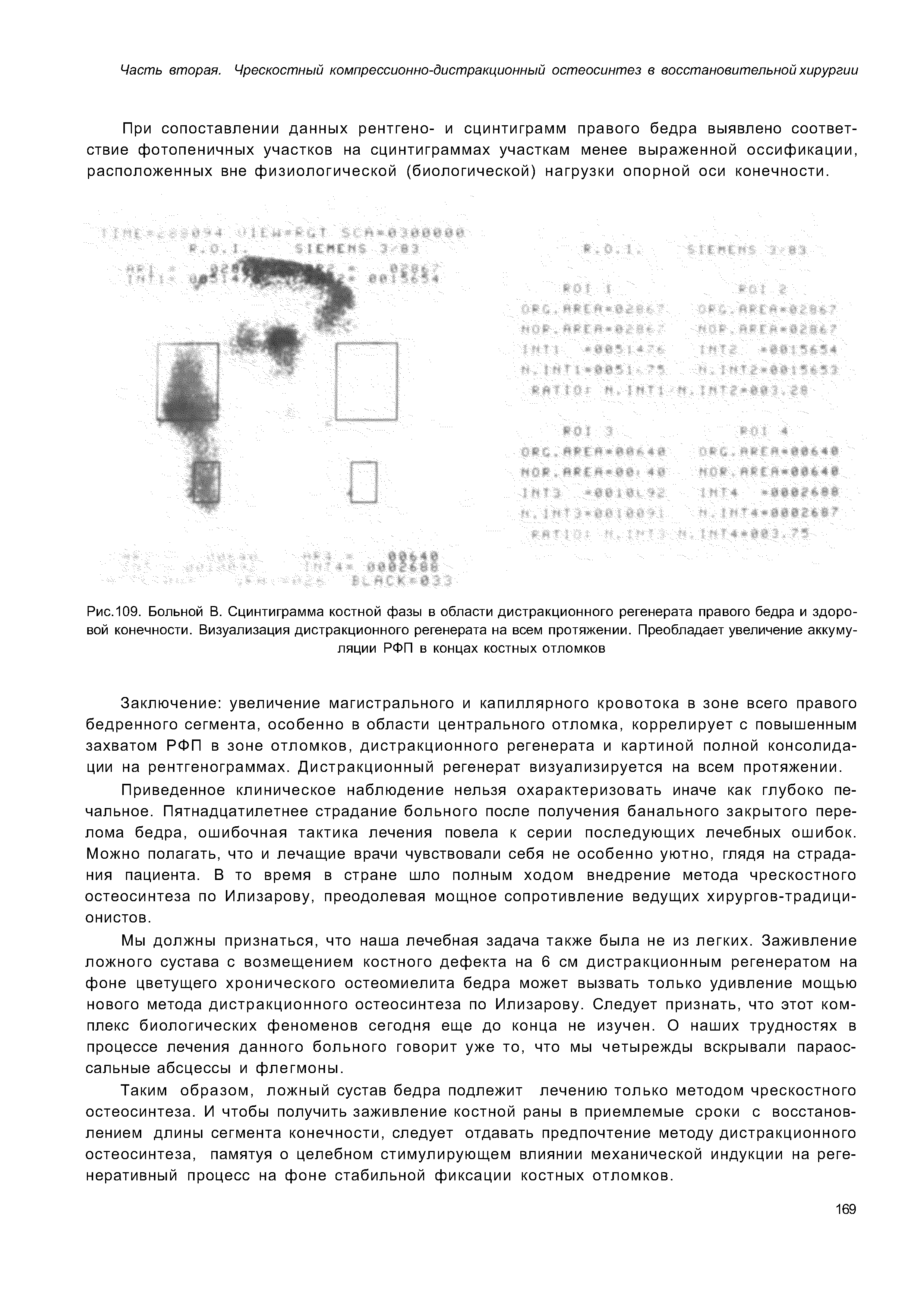 Рис. 109. Больной В. Сцинтиграмма костной фазы в области дистракционного регенерата правого бедра и здоровой конечности. Визуализация дистракционного регенерата на всем протяжении. Преобладает увеличение аккумуляции РФП в концах костных отломков...