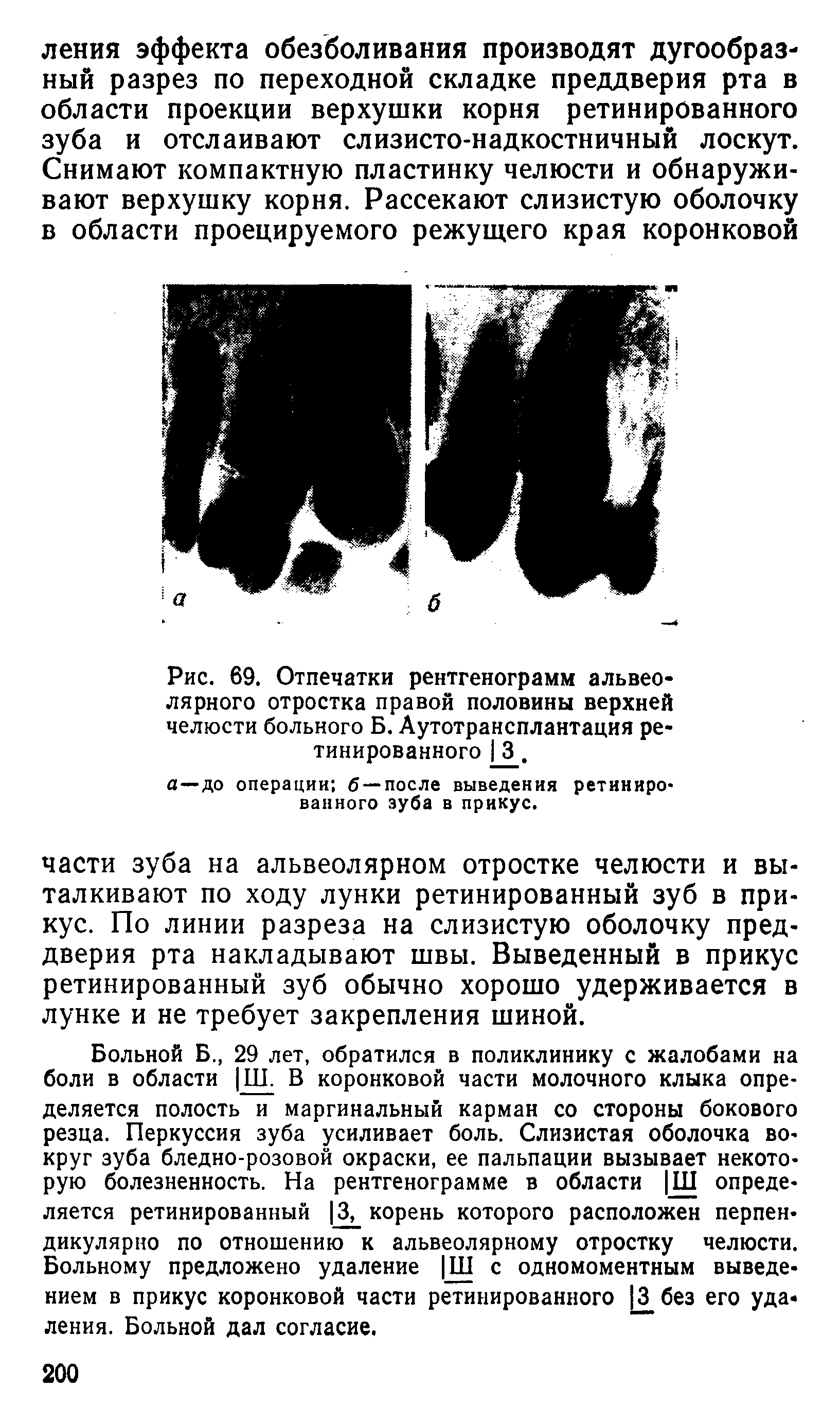 Рис. 69. Отпечатки рентгенограмм альвеолярного отростка правой половины верхней челюсти больного Б. Аутотрансплантация ретинированного 3.