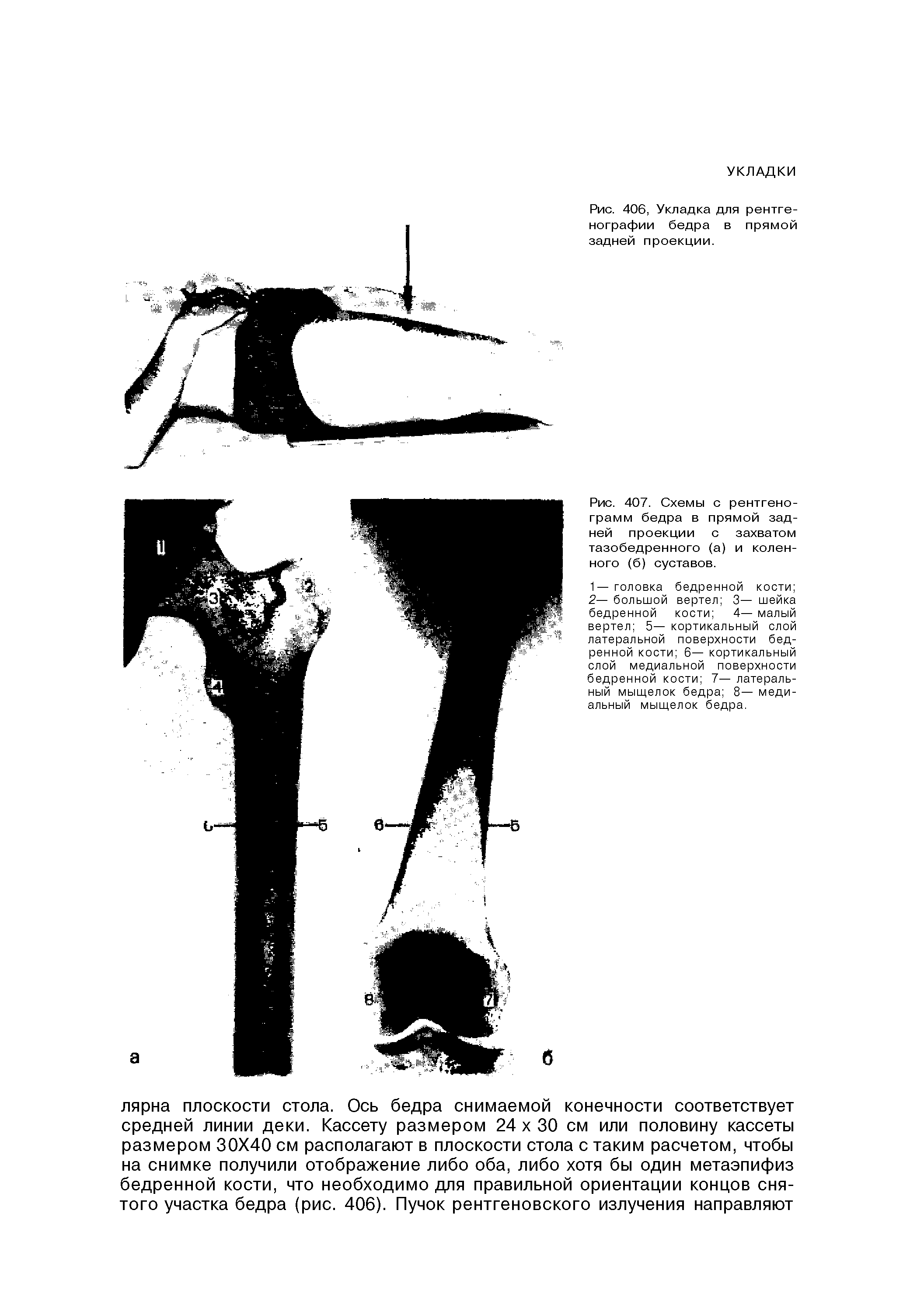 Рис. 406, Укладка для рентгенографии бедра в прямой задней проекции.