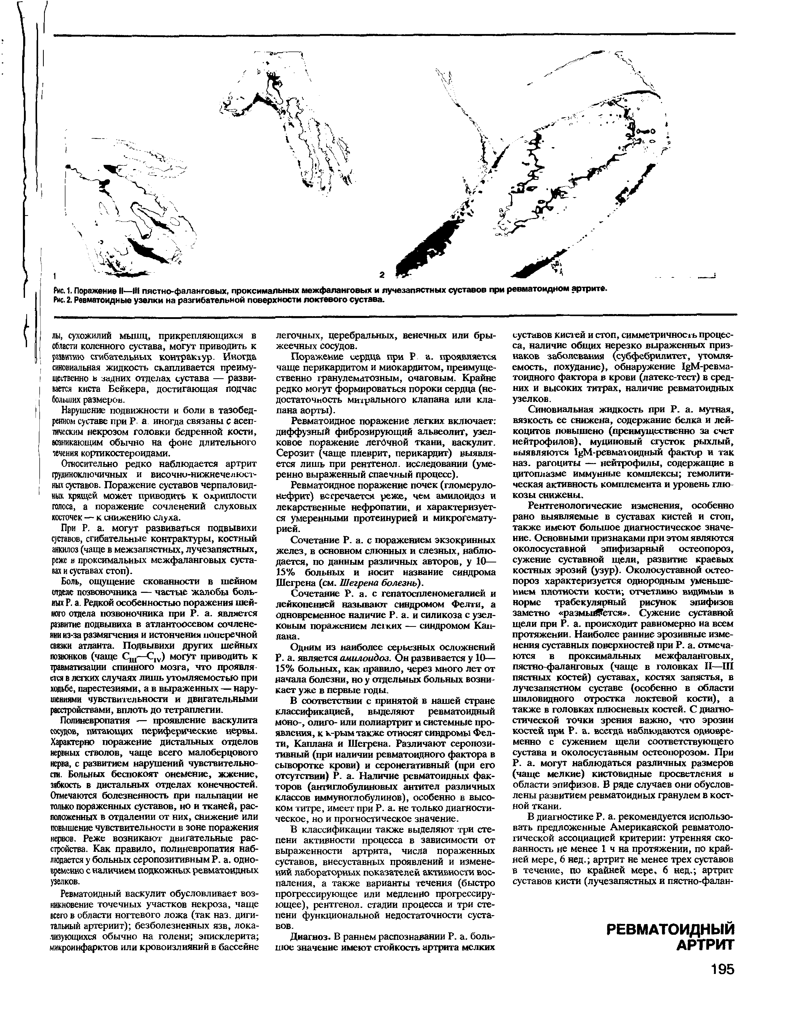 Рис. 1. Поражение II—III пястно-фаланговых, проксимальных межфаланговых и лучезапястных суставов при ревматоидном артрите. Рис. 2. Ревматоидные узелки на разгибательной поверхности локтевого сустава.