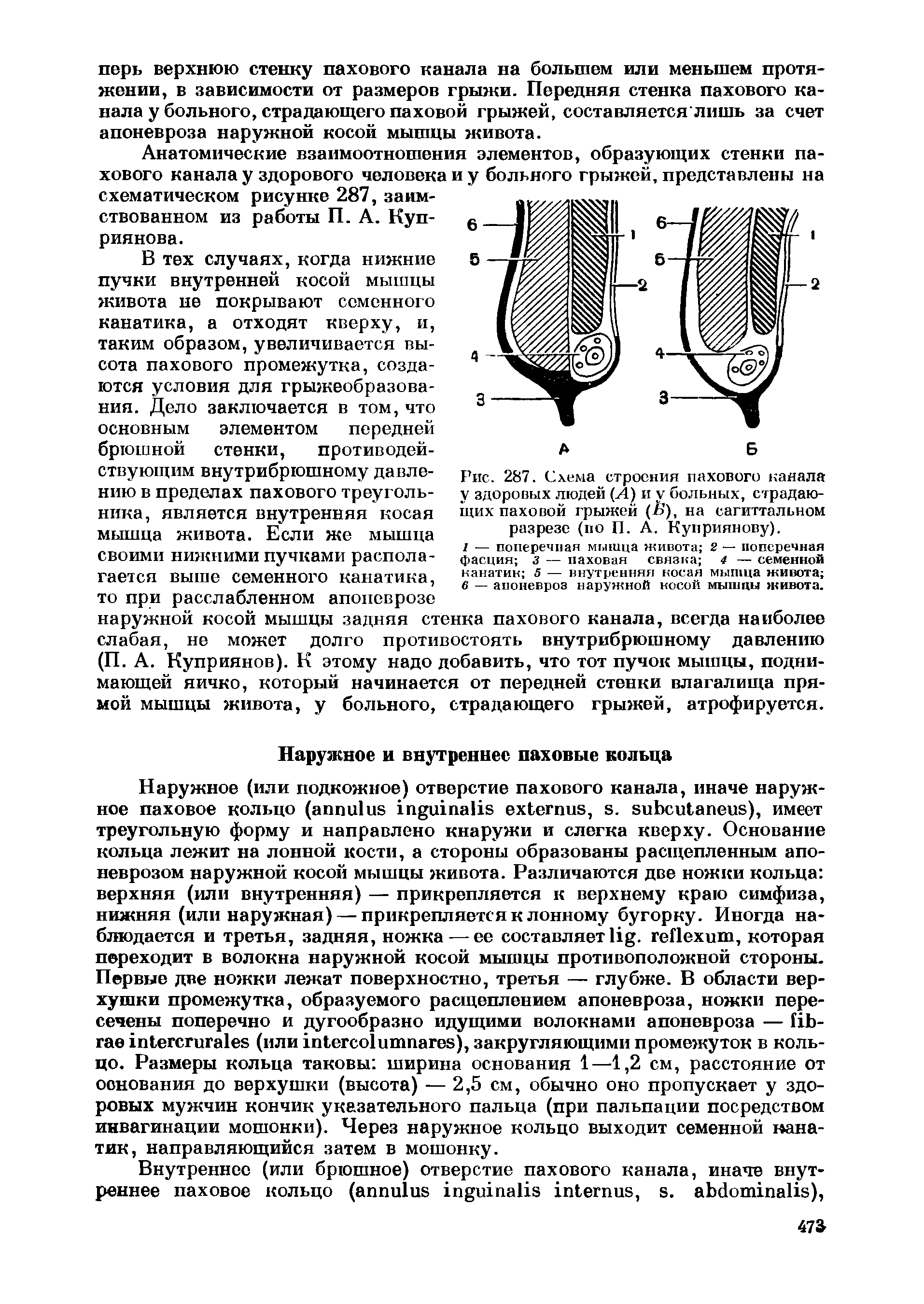 Рис. 287. Схема строения пахового наняла V здоровых людей (Л) и у больных, страдающих паховой грыжей (А), на сагиттальном разрезе (по П. А. Куприянову).