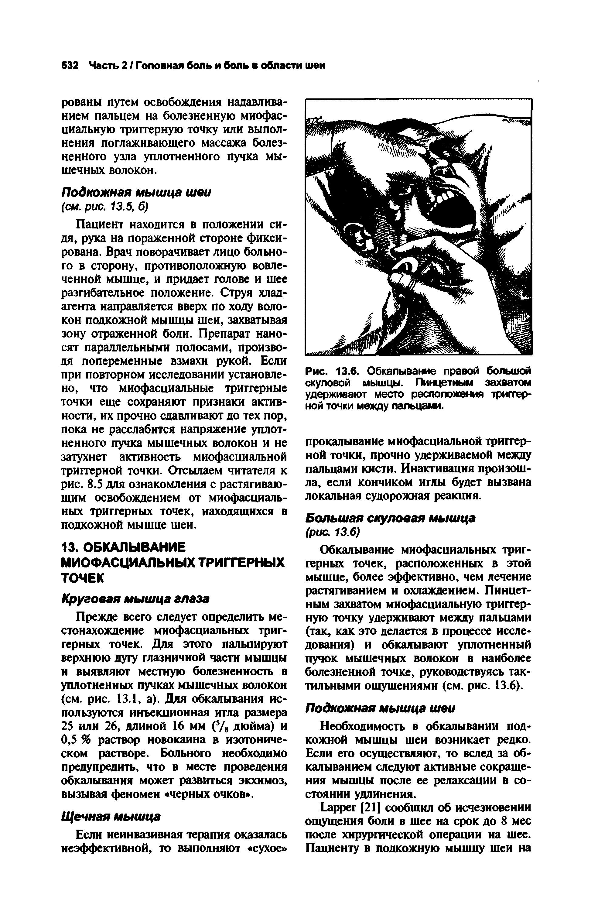 Рис. 13.6. Обкалывание правой большой скуловой мышцы. Пинцетным захватом удерживают место расположения триггерной точки между пальцами.