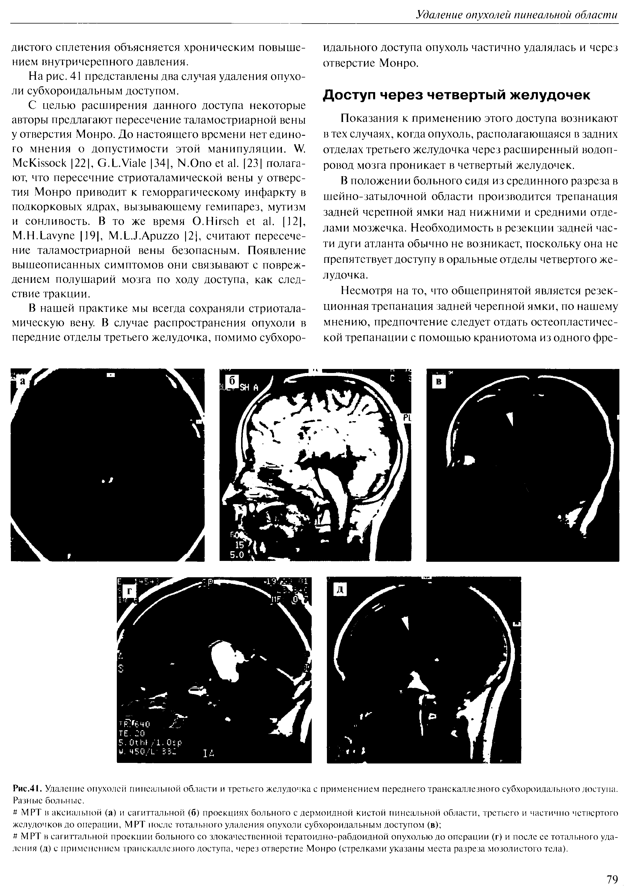 Рис.41. Удаление опухолей пинеальной области и третьего желудочка с применением переднего транскаллезного субхороидального доступа. Разные больные.