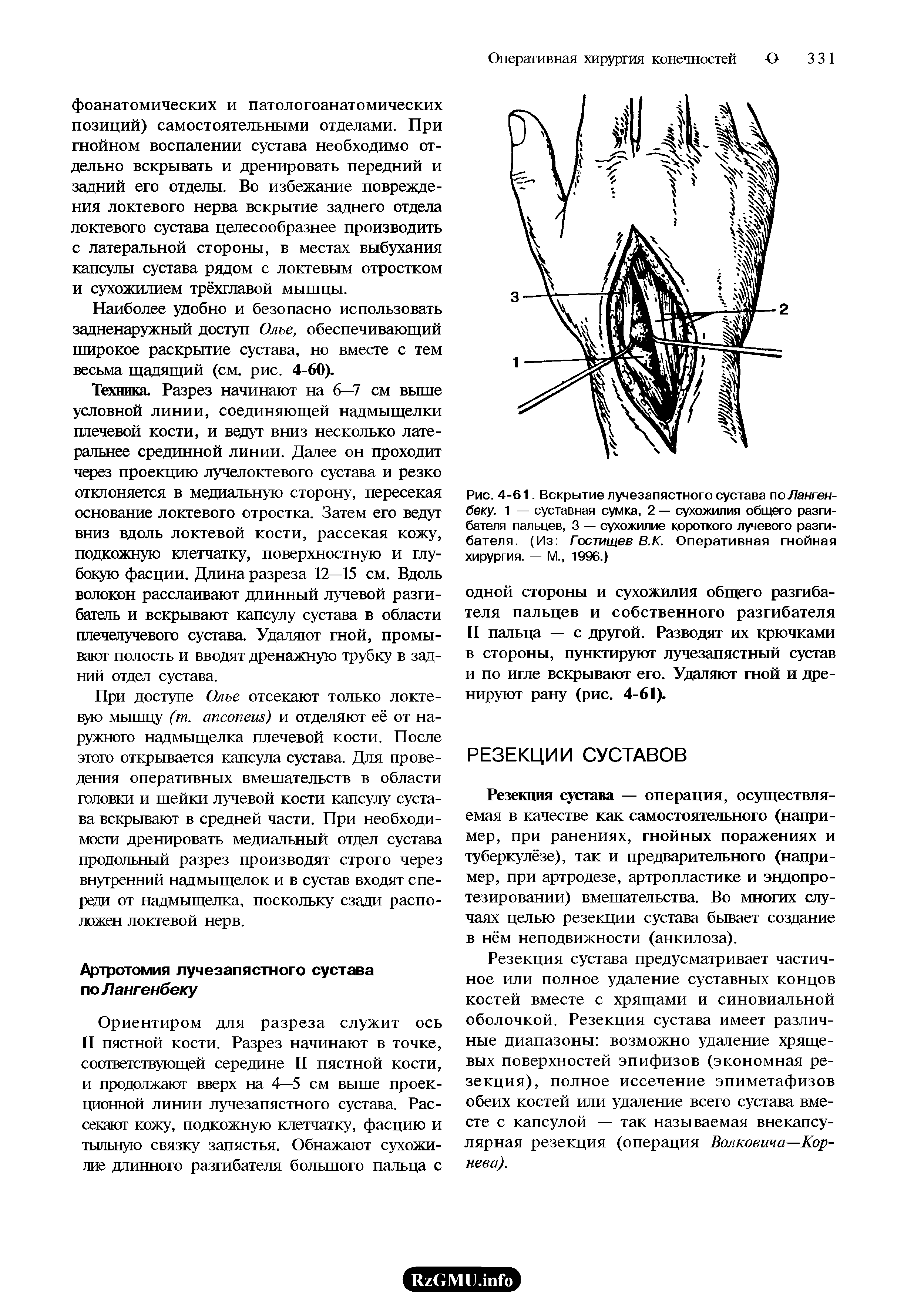 Рис. 4-61. Вскрытие лучезапястного сустава поЛангенбеку. 1 — суставная сумка, 2 — сухожилия общего разгибателя пальцев, 3 — сухожилие короткого лучевого разгибателя. (Из Гостищев В.К. Оперативная гнойная хирургия. — М., 1996.)...