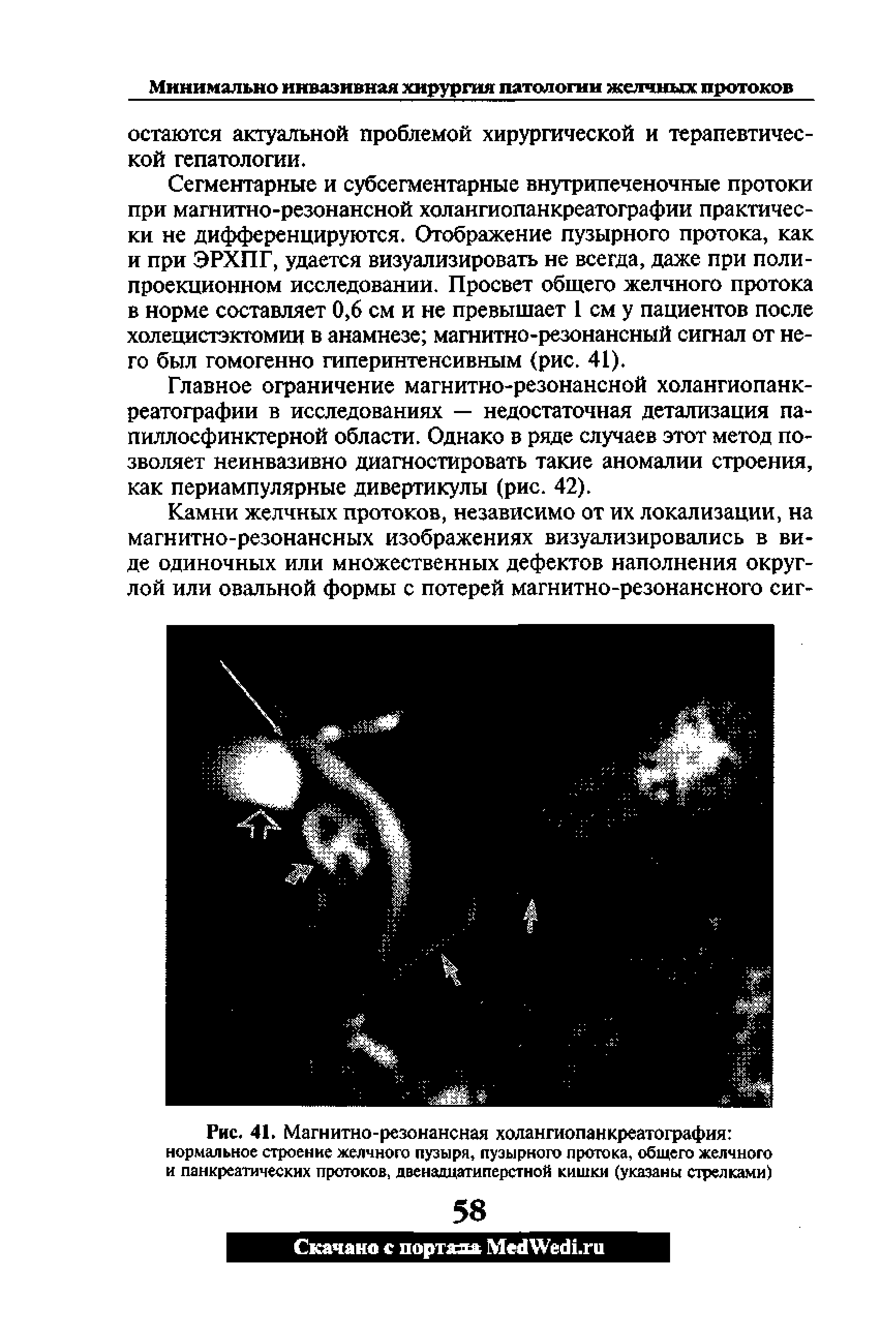 Рис. 41. Магнитно-резонансная холангиопанкреатография нормальное строение желчного пузыря, пузырного протока, общего желчного и панкреатических протоков, двенадцатиперстной кишки (указаны стрелками)...