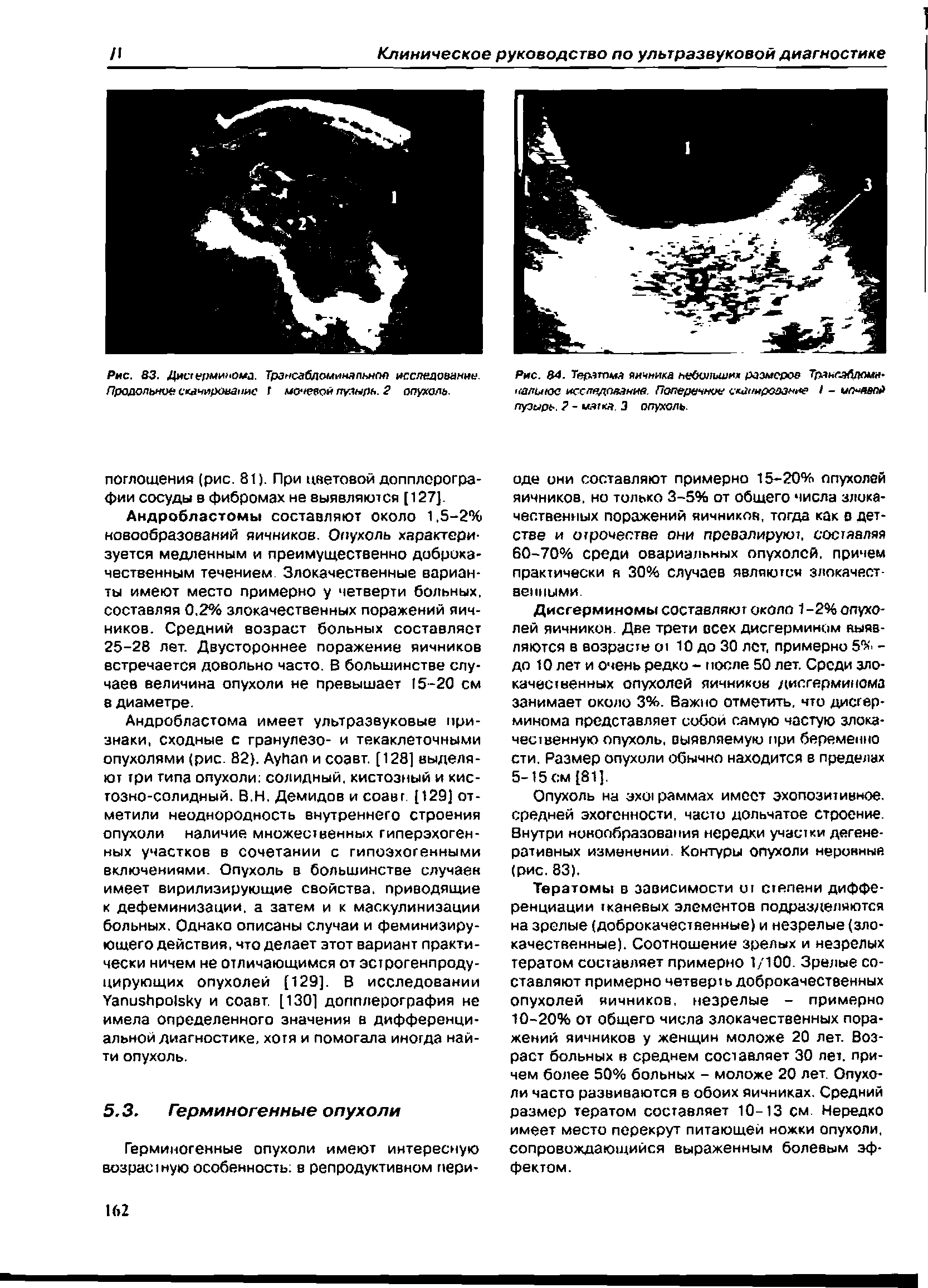 Рис. 84. Тератома яичника ьебынмим размеров ТраноэАпсшн-калыюо исследование. Поперечное сканнрсазнне I - ип далР пузырь. 2 - мягка. 3 опухоль.