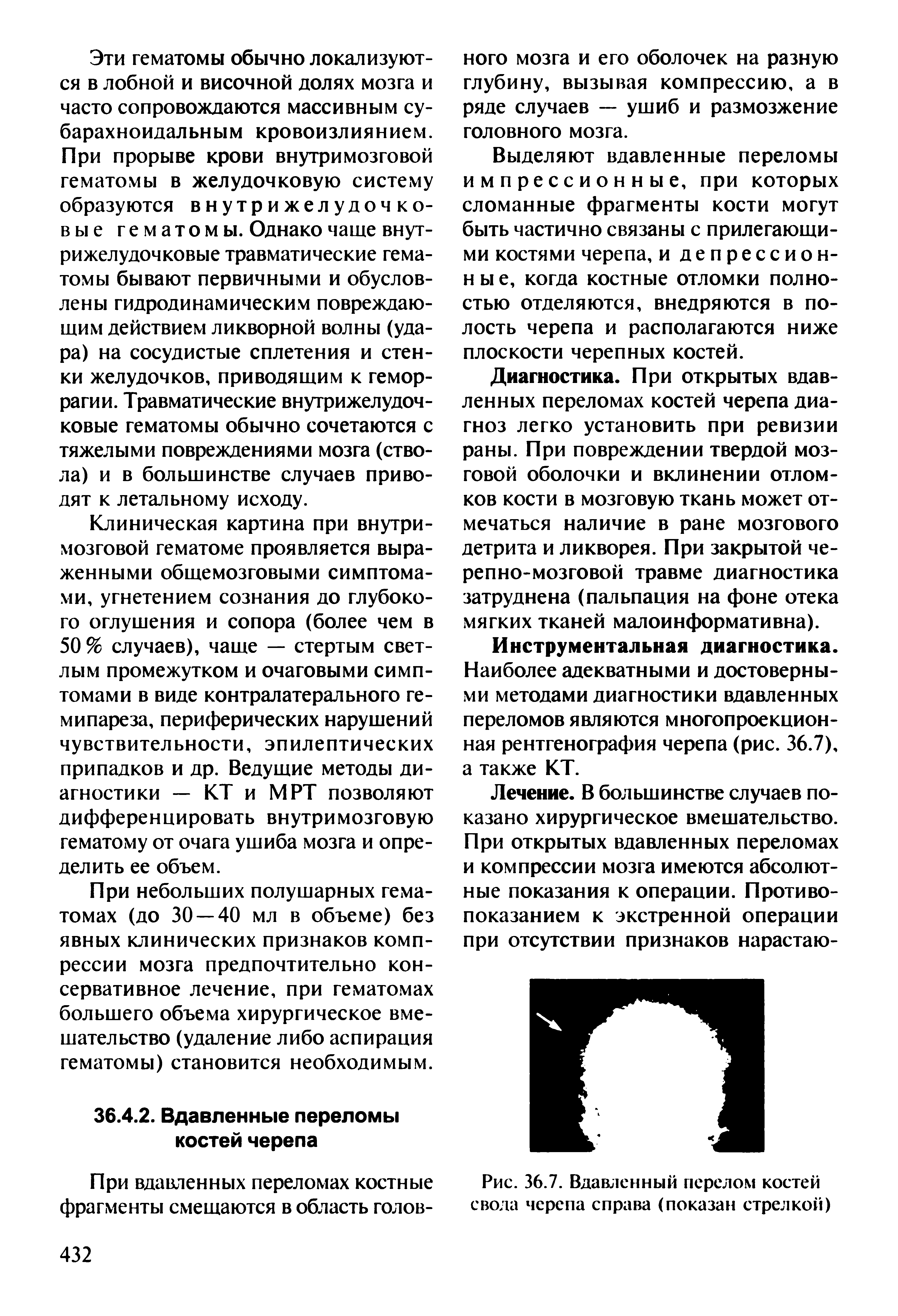 Рис. 36.7. Вдавленный перелом костей свода черепа справа (показан стрелкой)...