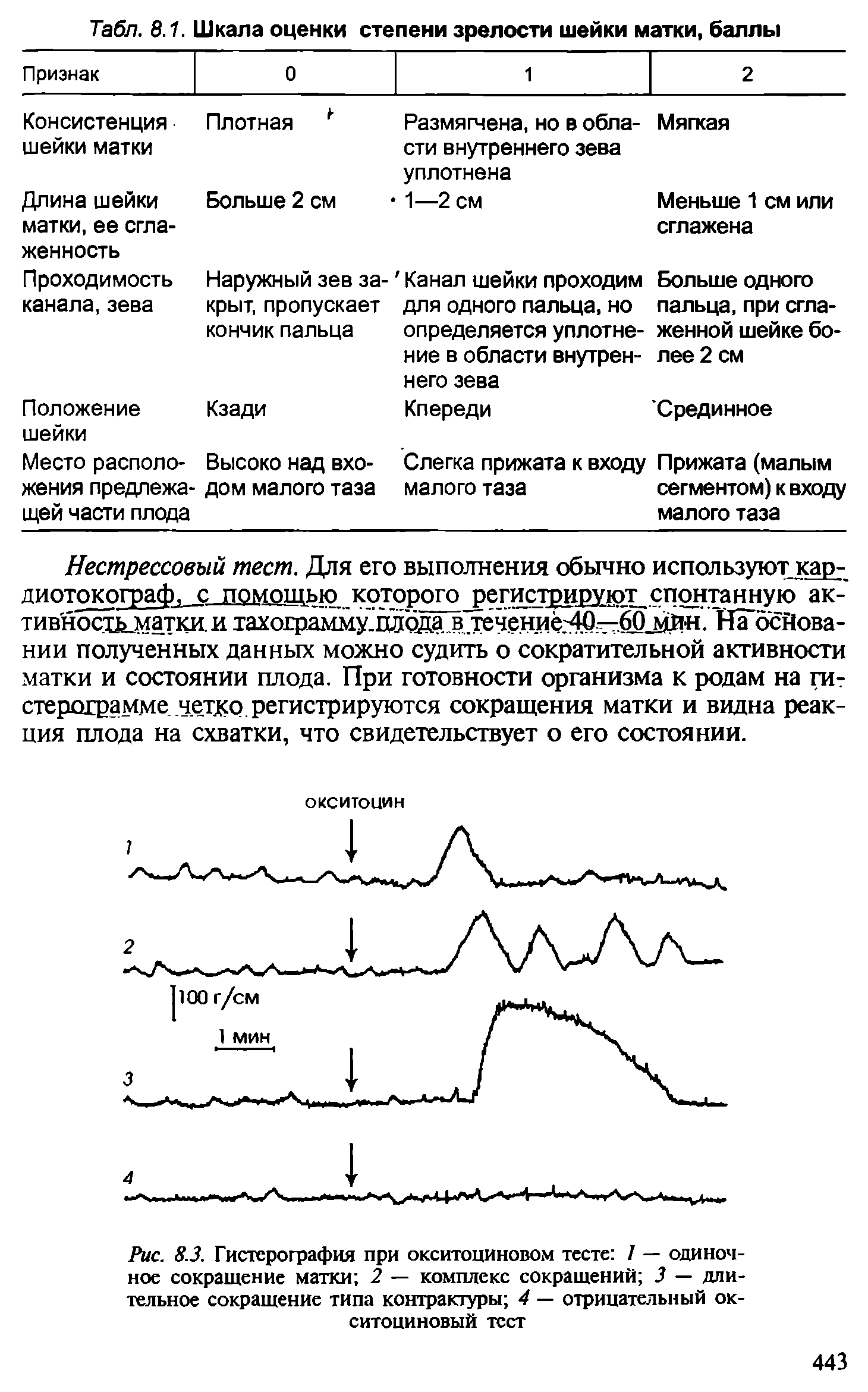 Рис. 8.3. Гистерография при окситоциновом тесте 1 — одиночное сокращение матки 2 — комплекс сокращений 3 — длительное сокращение типа контрактуры 4 — отрицательный окситоциновый тест...