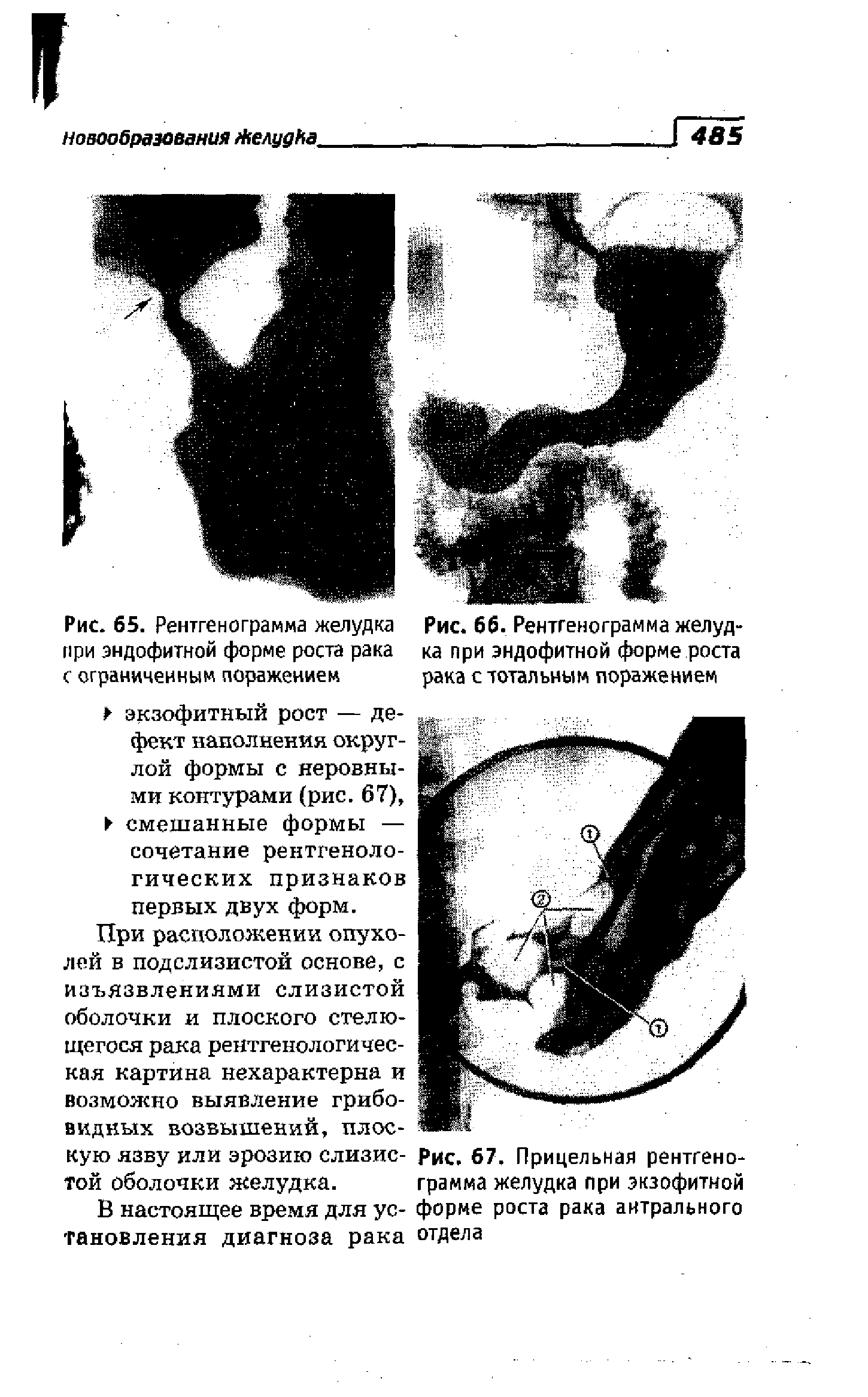 Рис. 66. Рентгенограмма желудка при эндофитной форме роста рака с тотальным поражением...