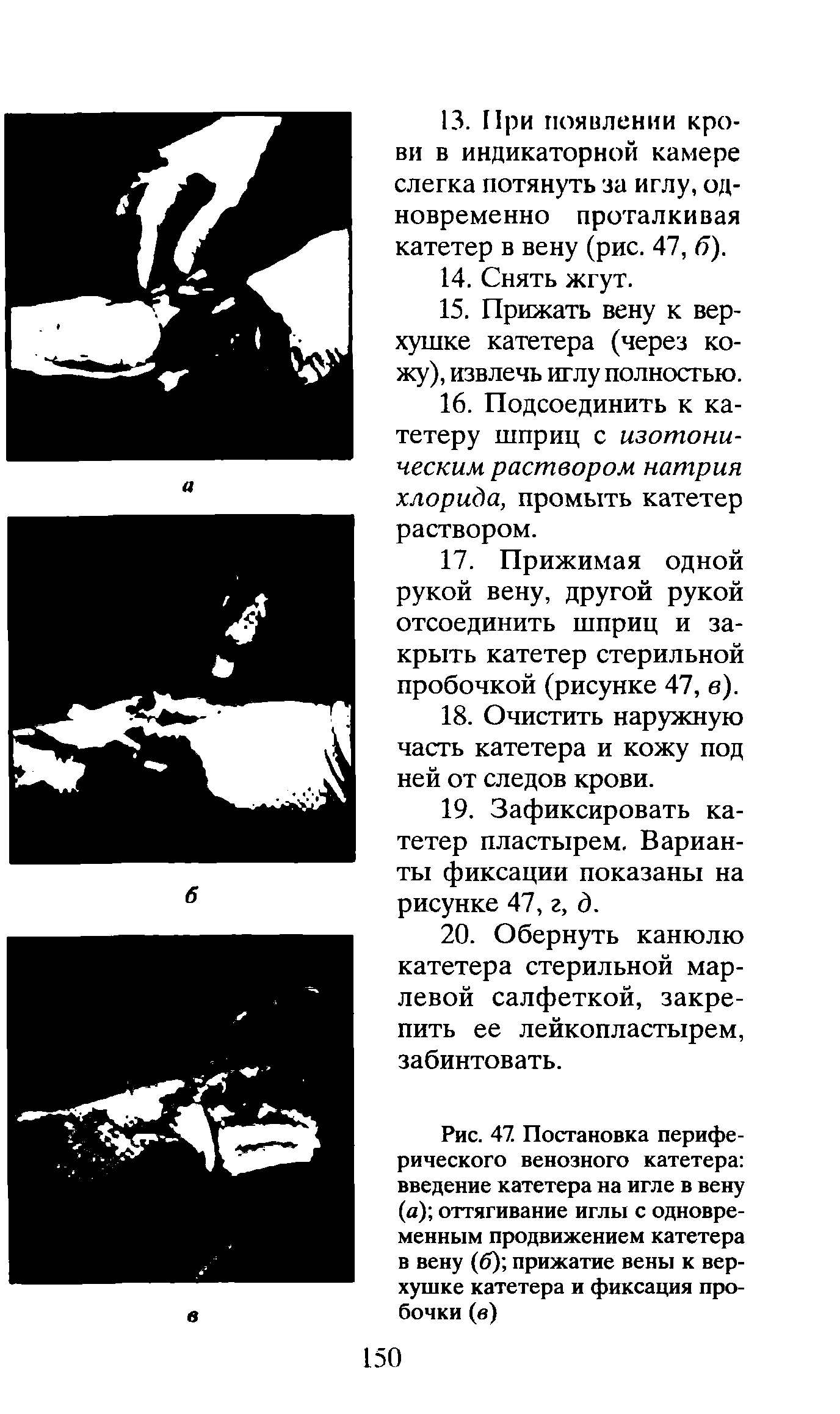 Рис. 47. Постановка периферического венозного катетера введение катетера на игле в вену (а) оттягивание иглы с одновременным продвижением катетера в вену (б) прижатие вены к верхушке катетера и фиксация пробочки (в)...