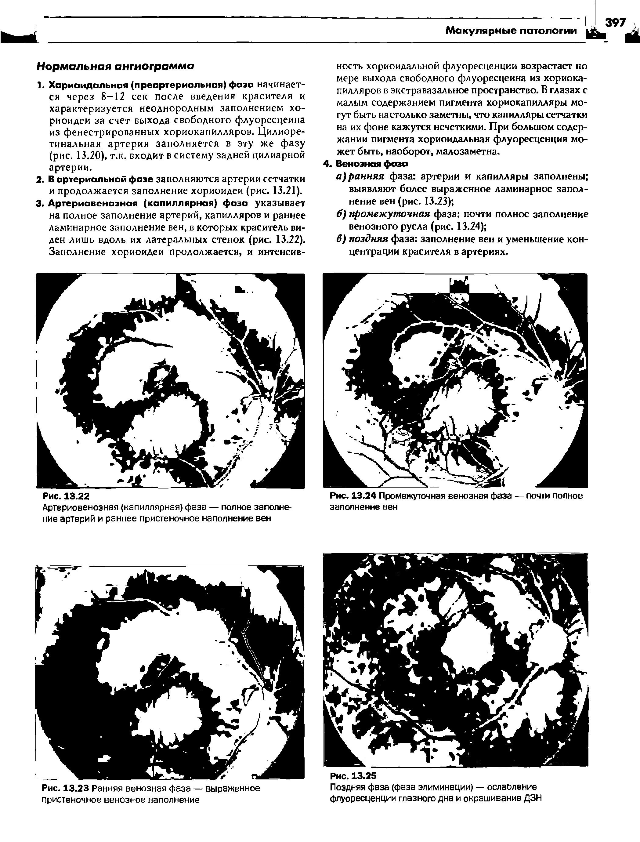 Рис. 13.23 Ранняя венозная фаза — выраженное Поздняя фаза (фаза элиминации) — ослабление...