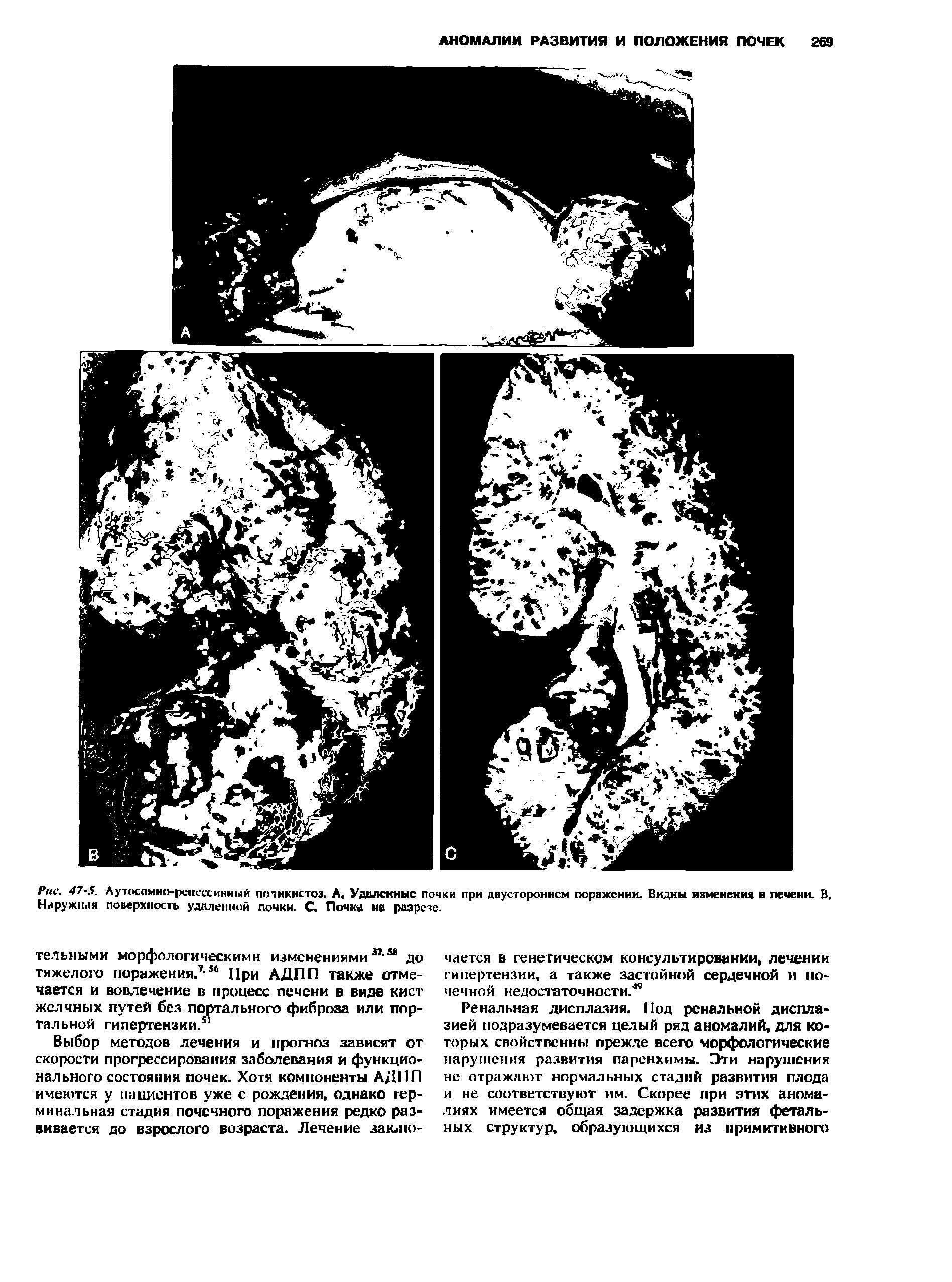 Рис. 47-5. Аут<к амнсьр< це(хинн1> й потикистоз. А, Удплскныс почки при двустороннем поражении. Видны изменения в печени. В, Наружная поверхность удаленной почки. С. Почку на разрезе.