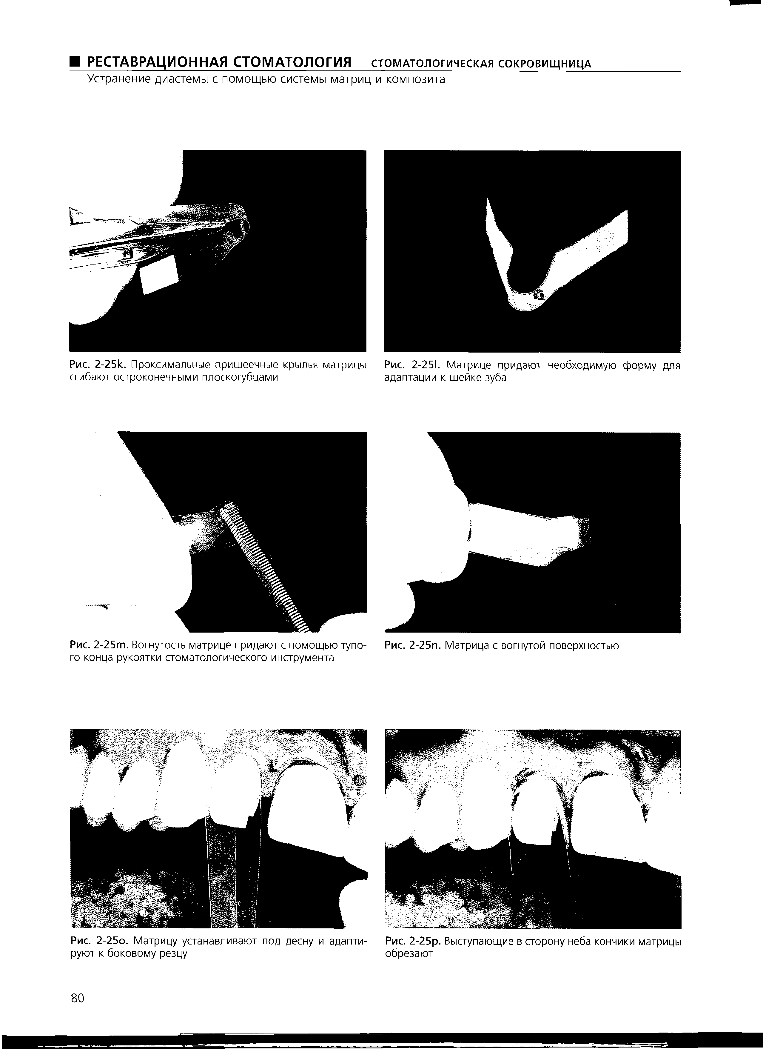 Рис. 2-251. Матрице придают необходимую форму для адаптации к шейке зуба...