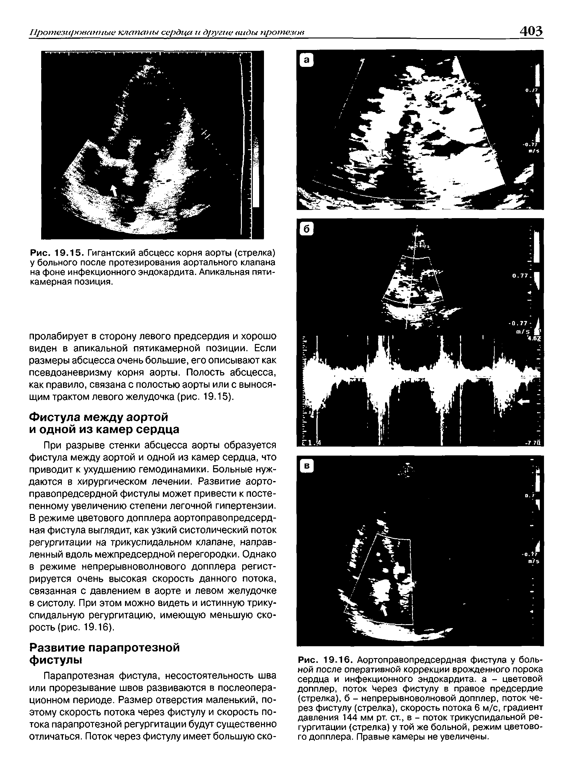 Рис. 19.16. Аортоправопредсердная фистула у больной после оперативной коррекции врожденного порока сердца и инфекционного эндокардита, а - цветовой допплер, поток Через фистулу в правое предсердие (стрелка), б - непрерывноволновой допплер, поток через фистулу (стрелка), скорость потока 6 м/с, градиент давления 144 мм рт. ст., в - поток трикуспидальной регургитации (стрелка) у той же больной, режим цветового допплера. Правые камеры не увеличены.