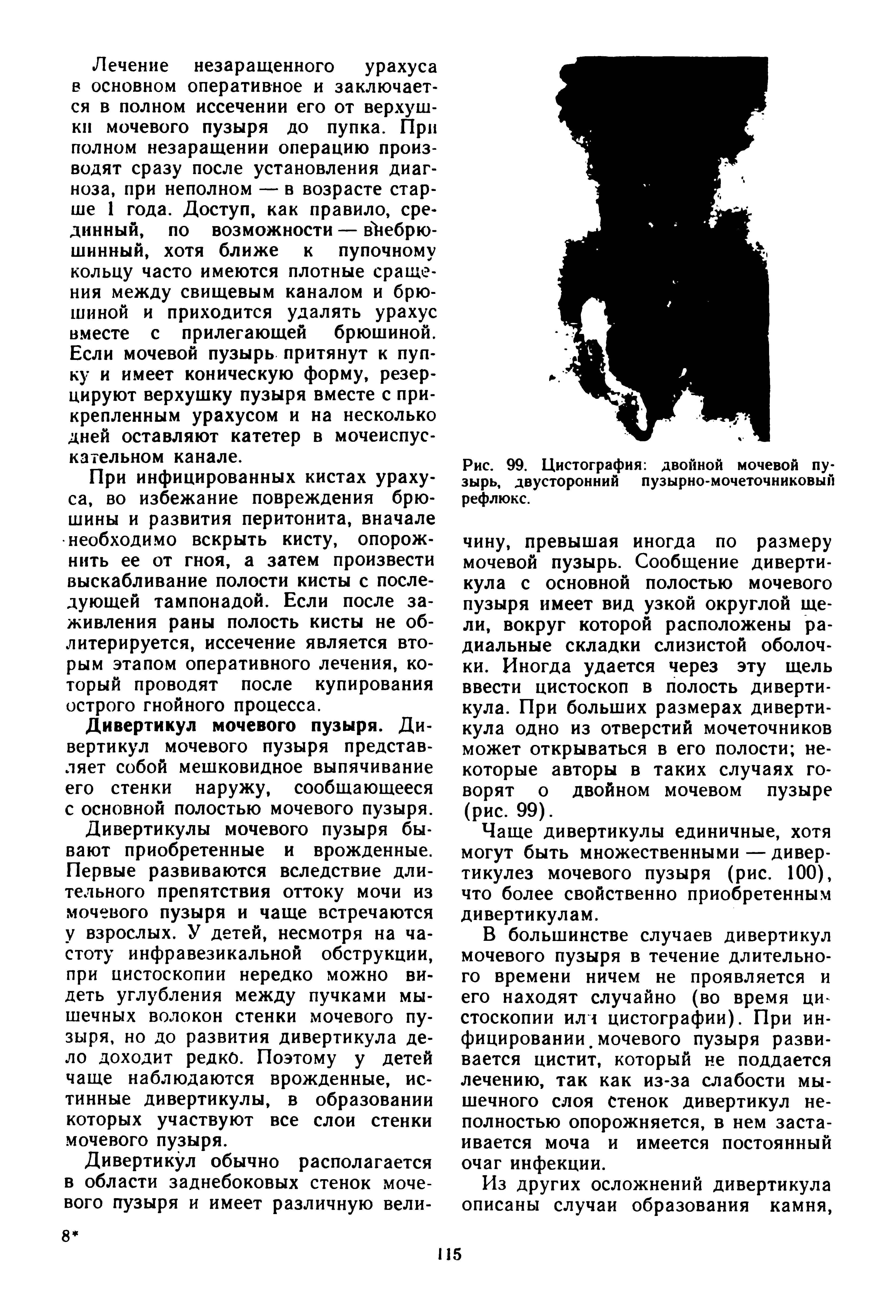 Рис. 99. Цистография двойной мочевой пузырь, двусторонний пузырно-мочеточниковый рефлюкс.