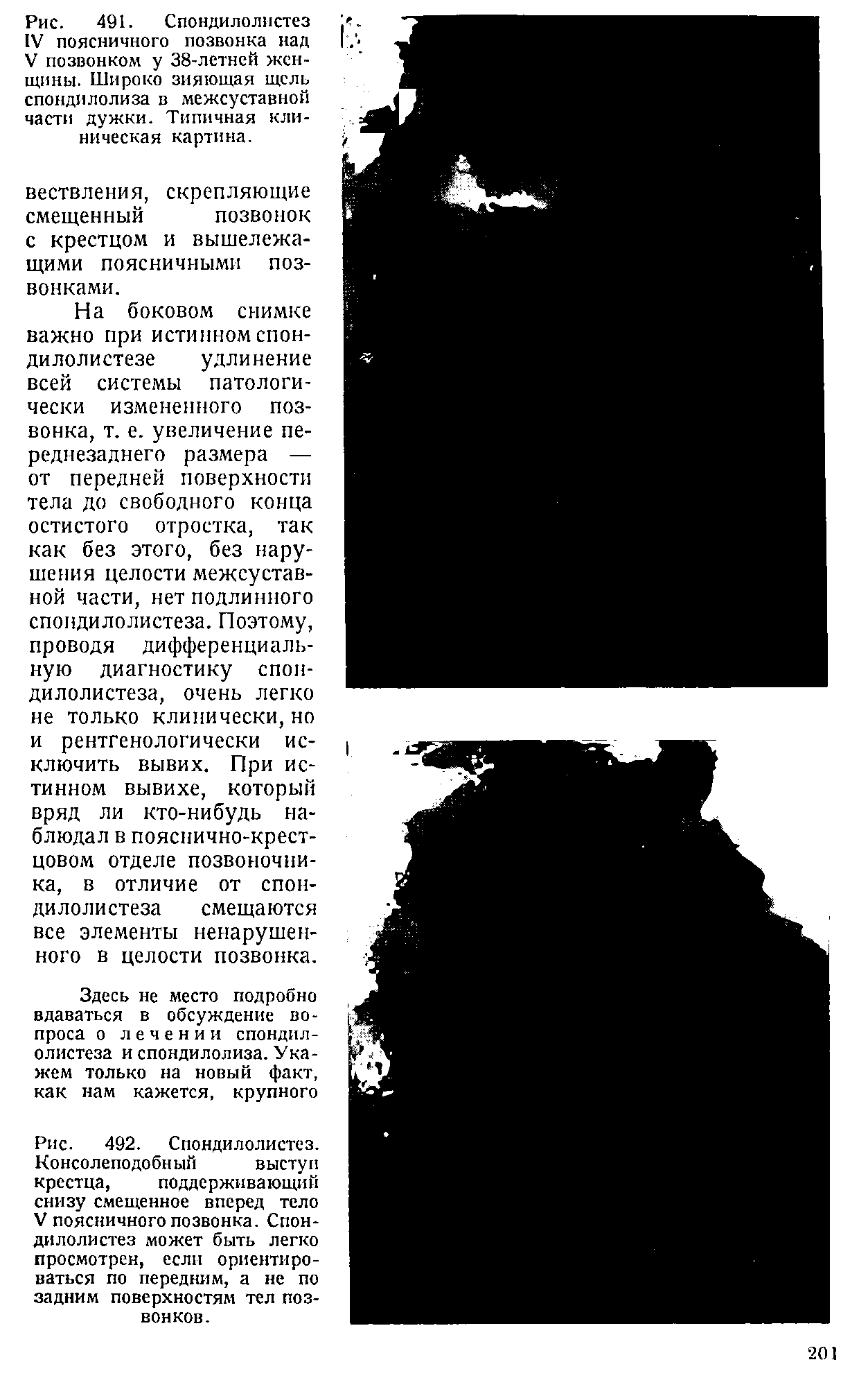 Рис. 492. Спондилолистез. Консолеподобный выступ крестца, поддерживающий снизу смещенное вперед тело V поясничного позвонка. Спондилолистез может быть легко просмотрен, если ориентироваться по передним, а не по задним поверхностям тел позвонков.