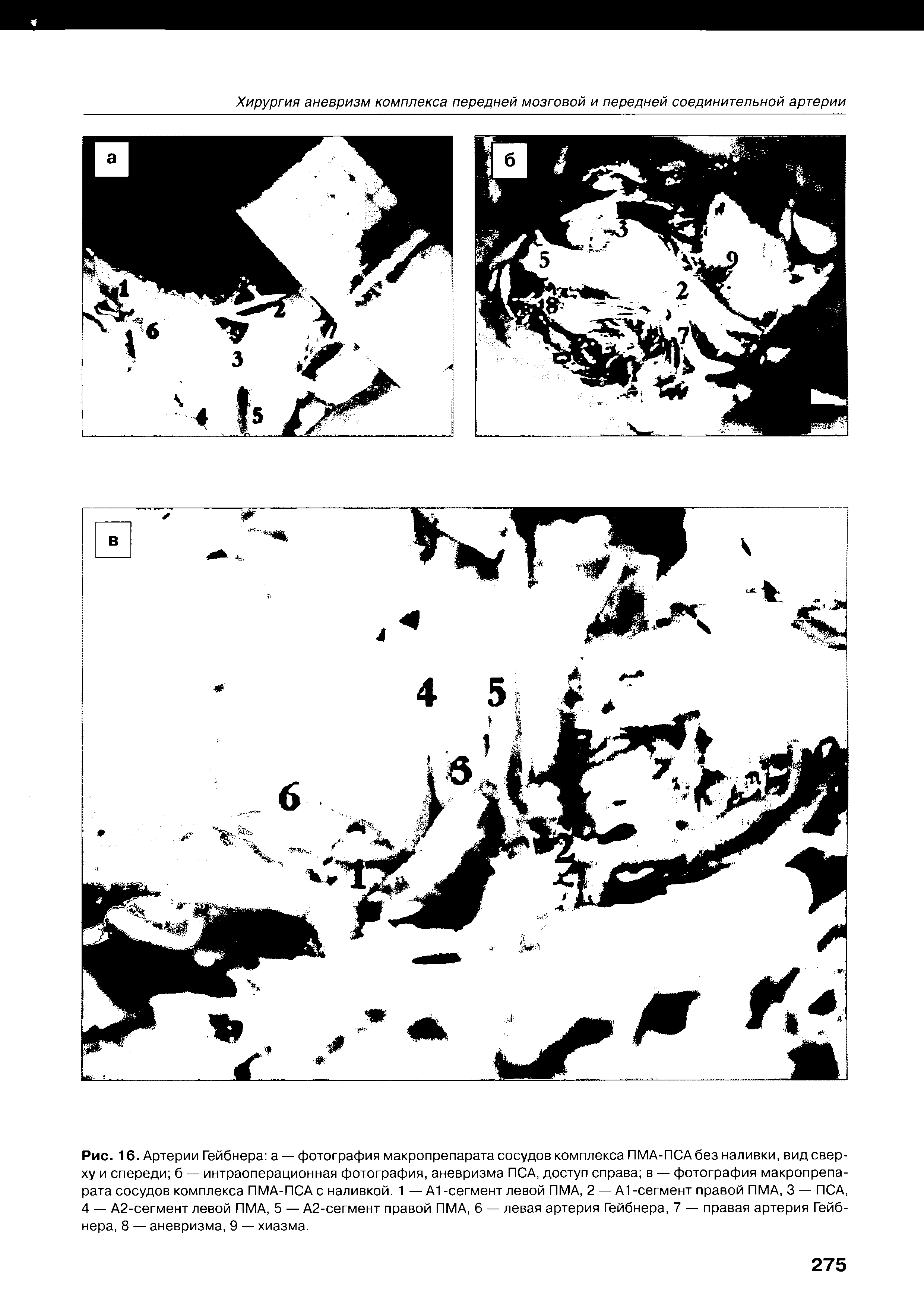 Рис. 16. Артерии Гейбнера а — фотография макропрепарата сосудов комплекса ПМА-ПСАбез наливки, вид сверху и спереди б — интраоперационная фотография, аневризма ПСА, доступ справа в — фотография макропрепарата сосудов комплекса ПМА-ПСА с наливкой. 1 — А1 -сегмент левой ПМА, 2 — А1 -сегмент правой ПМА, 3 — ПСА, 4 — А2-сегмент левой ПМА, 5 — А2-сегмент правой ПМА, 6 — левая артерия Гейбнера, 7 — правая артерия Гейбнера, 8 — аневризма, 9 — хиазма.