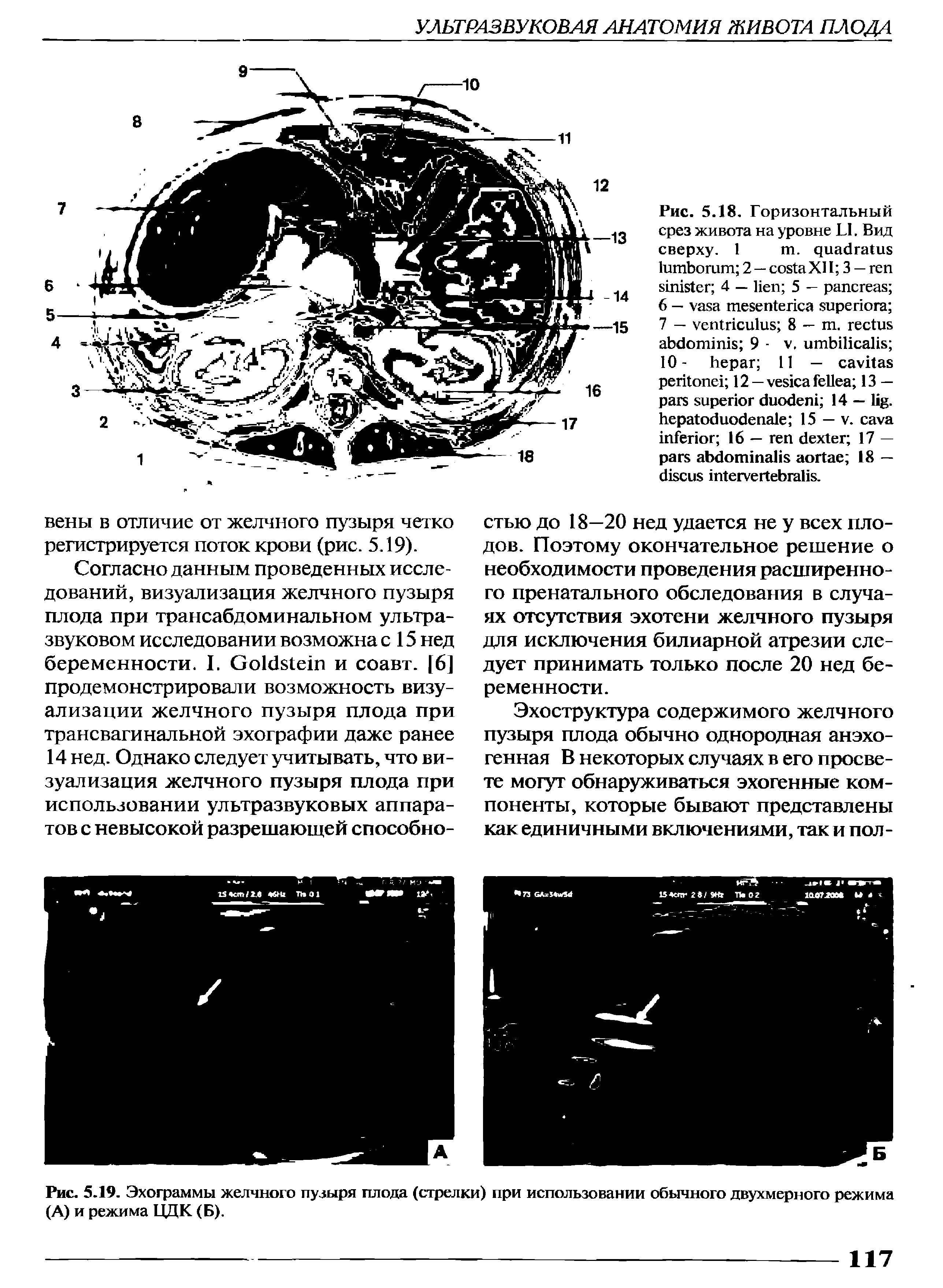 Рис. 5.19. Эхограммы желчного пузыря плода (стрелки) при использовании обычного двухмерного режима (А) и режима ЦДК (Б).