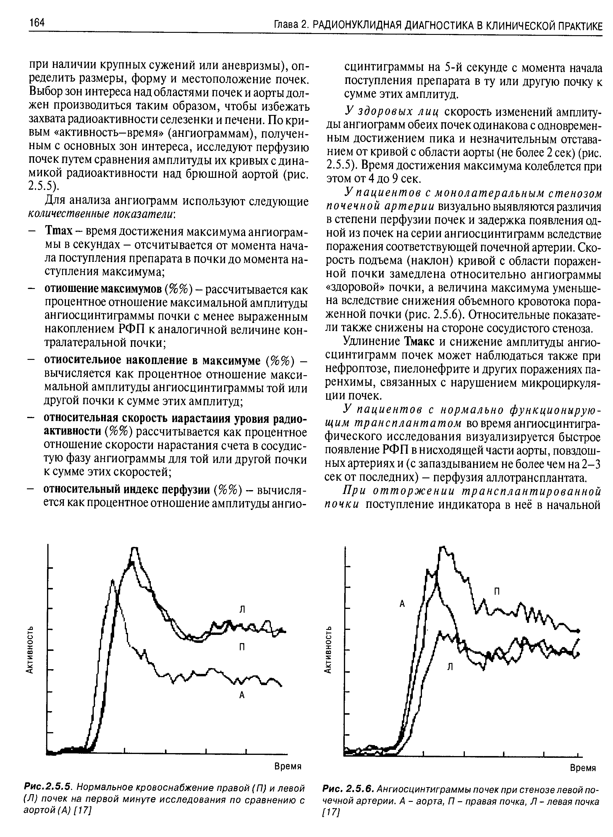 Рис. 2.5.6. Ангиосцинтиграммы почек при стенозе левой почечной артерии. А - аорта, П - правая почка, Л - левая почка [17]...