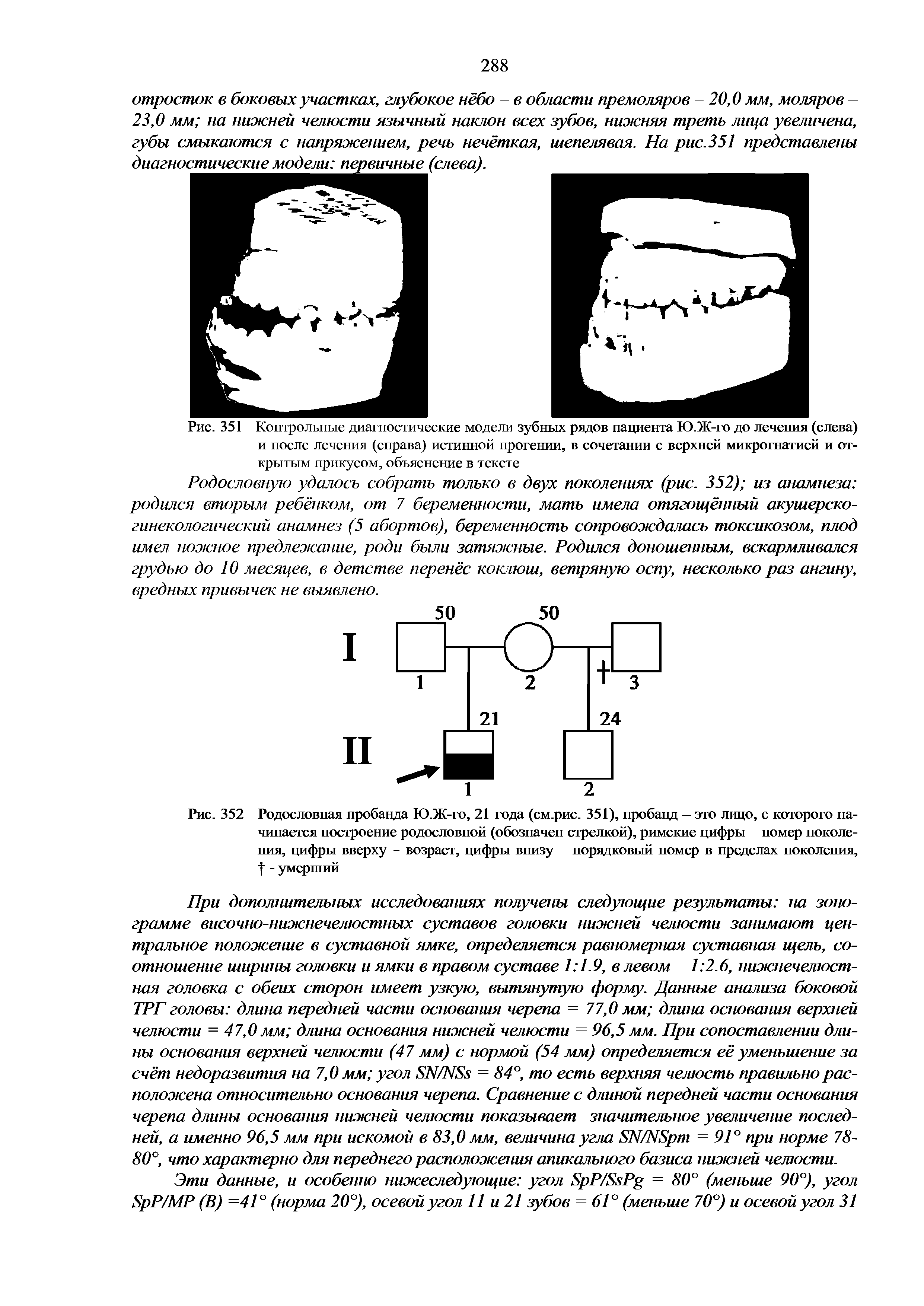 Рис. 352 Родословная пробанда Ю.Ж-го, 21 года (см.рис. 351), пробанд это лицо, с которого начинается построение родословной (обозначен стрелкой), римские цифры номер поколения, цифры вверху - возраст, цифры внизу порядковый номер в пределах поколения, - умерший...