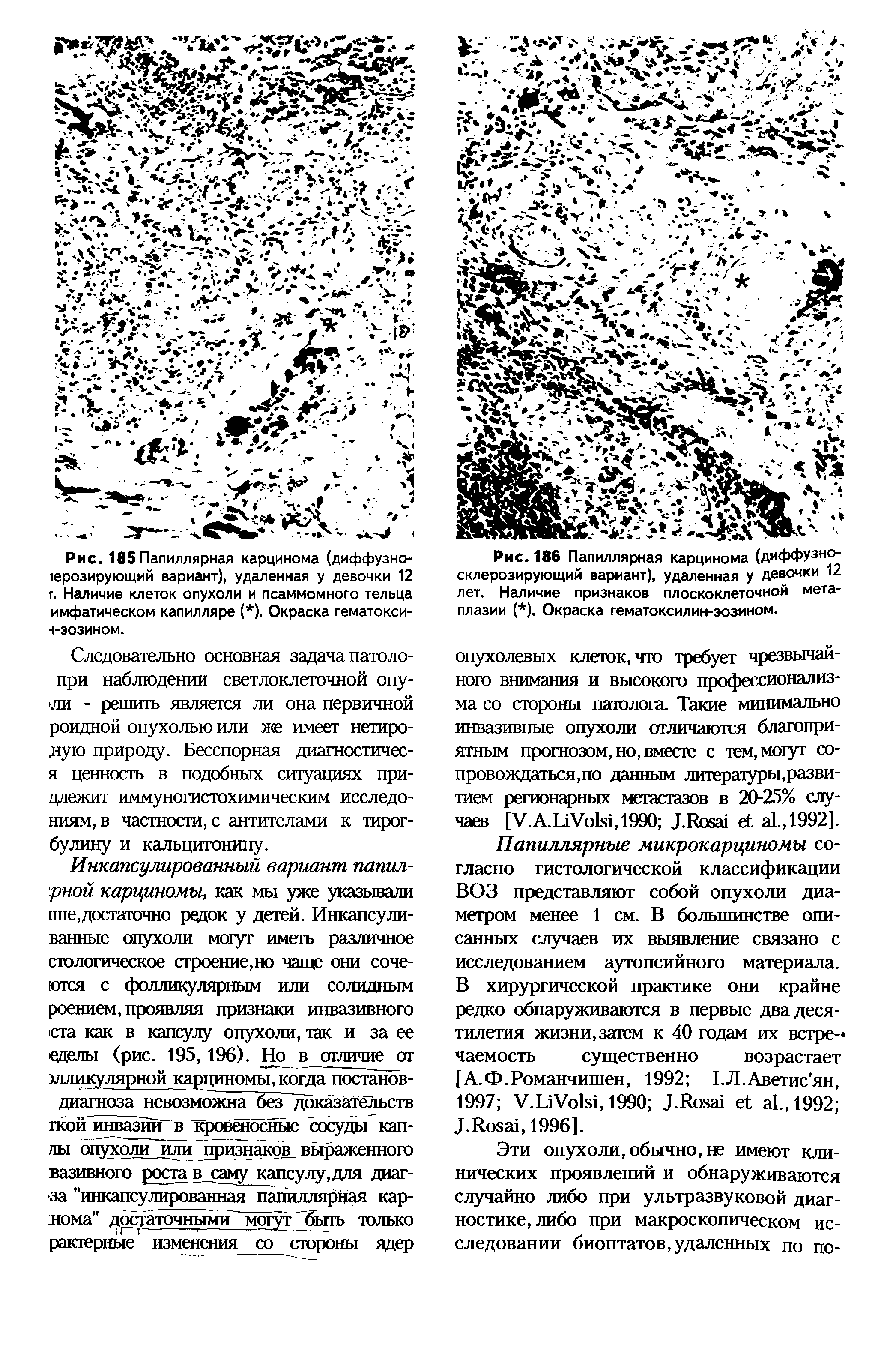 Рис. 186 Папиллярная карцинома (диффУзно склерозирующий вариант), удаленная у девочки 12 лет. Наличие признаков плоскоклеточной метаплазии ( ). Окраска гематоксилин-эозином.