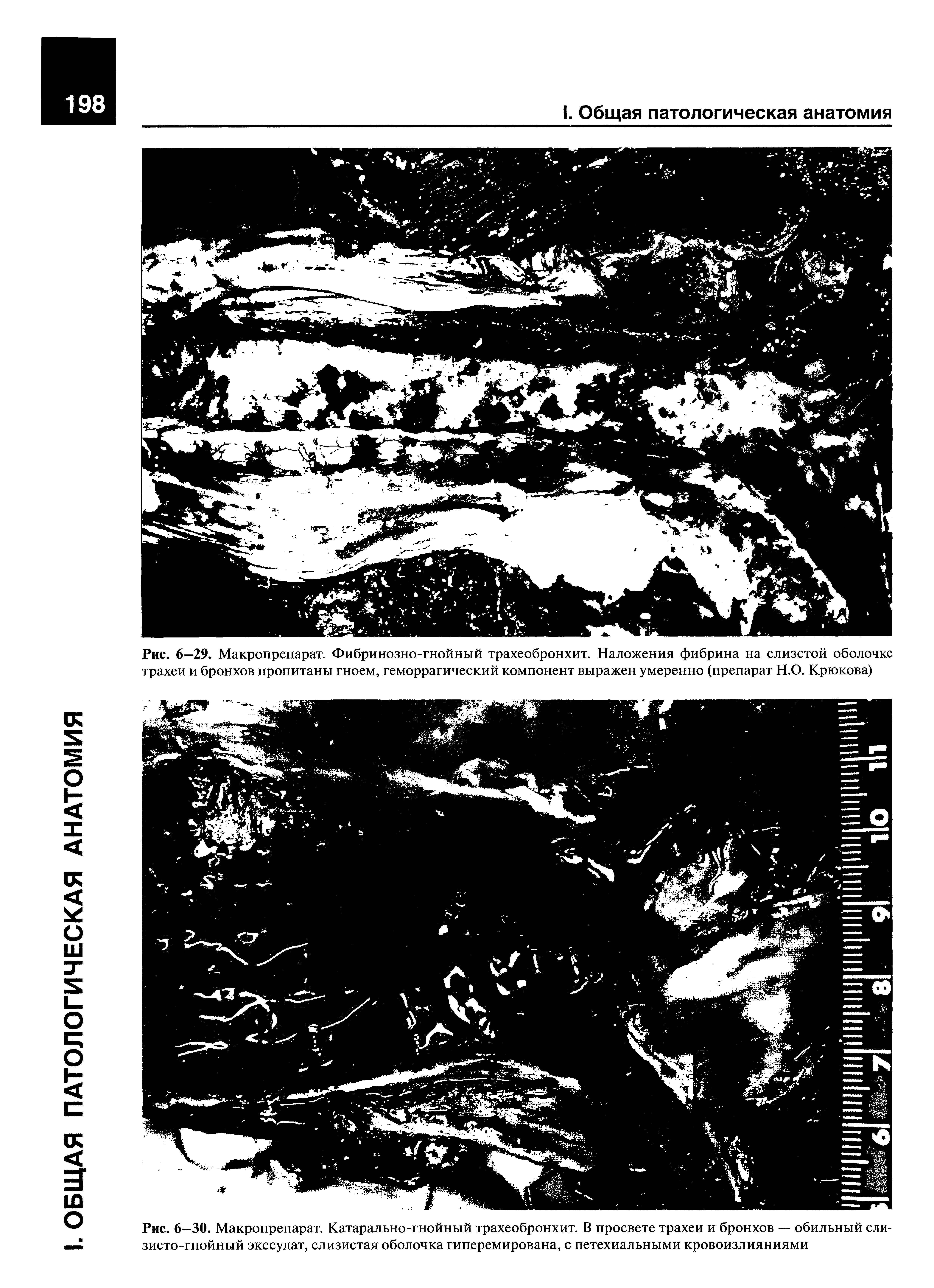 Рис. 6—29. Макропрепарат. Фибринозно-гнойный трахеобронхит. Наложения фибрина на слизстой оболочке трахеи и бронхов пропитаны гноем, геморрагический компонент выражен умеренно (препарат Н.О. Крюкова)...