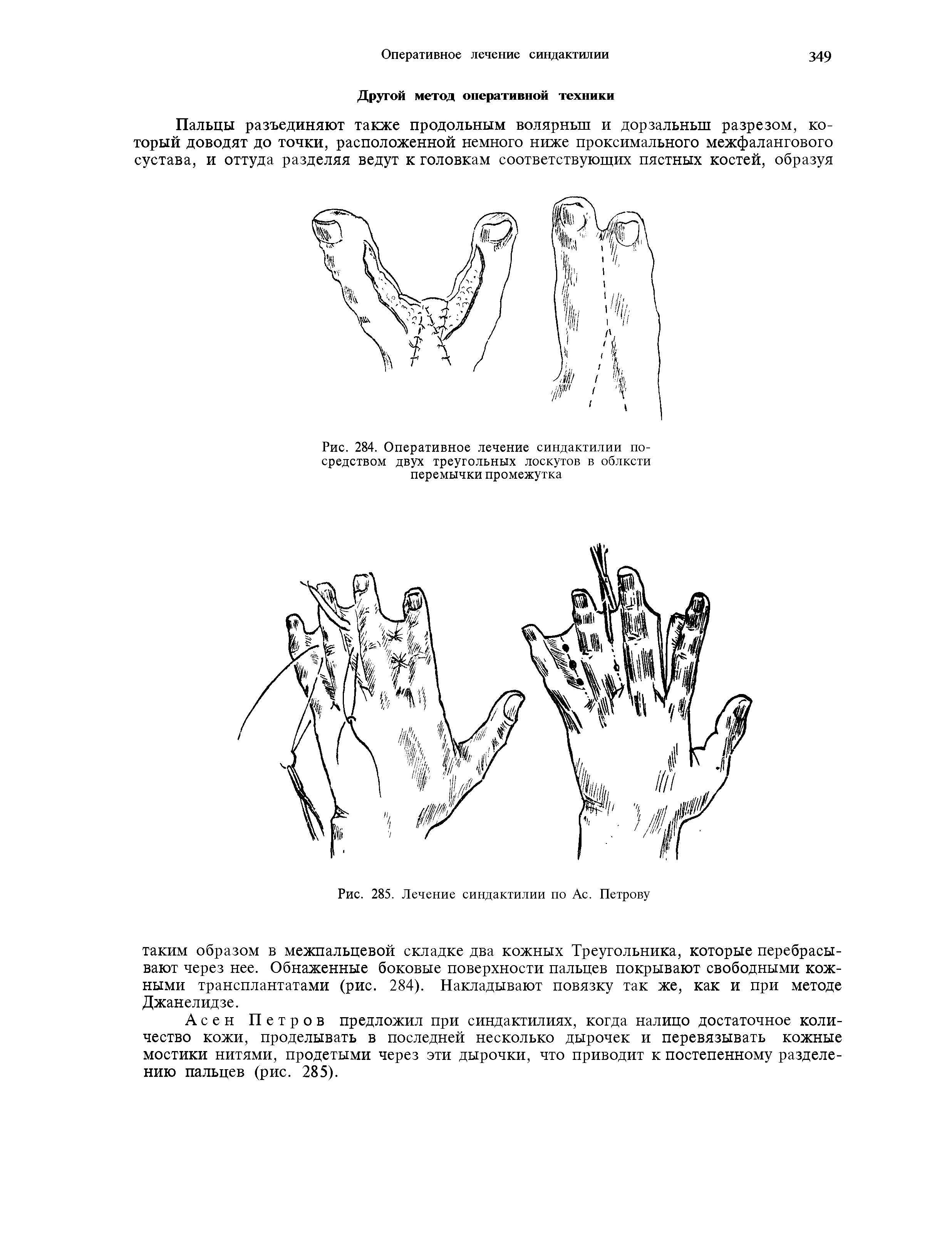 Рис. 284. Оперативное лечение синдактилии посредством двух треугольных лоскутов в облксти перемычки промежутка...