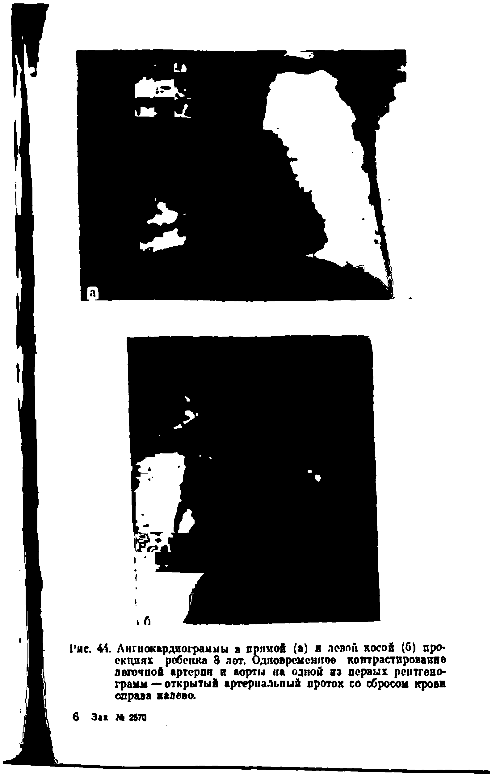 Рис. 41. Ангиокардиограммы в прямой (а) и повой косой (б) проекциях ребенка 8 лот. Одновременное коптрастпровапие легочной артерпн и аорты на одной на первых рентгенограмм — открытый артериальный проток со сбросом крови справа налево.