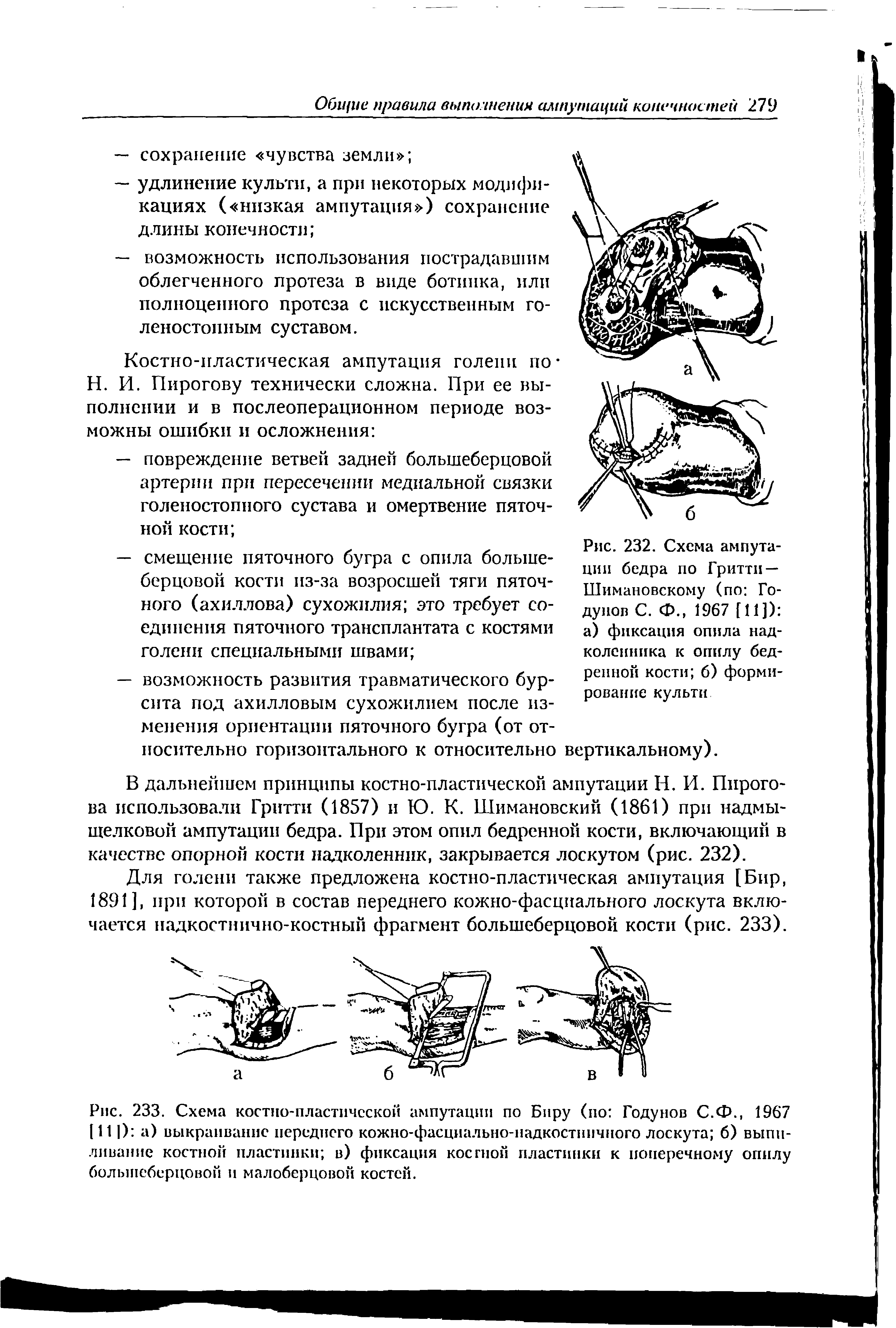 Рис. 232. Схема ампутации бедра по Гритти — Шимановскому (по Годунов С. Ф., 1967 [11]) а) фиксация опила надколенника к опилу бедренной кости 6) формирование культи...