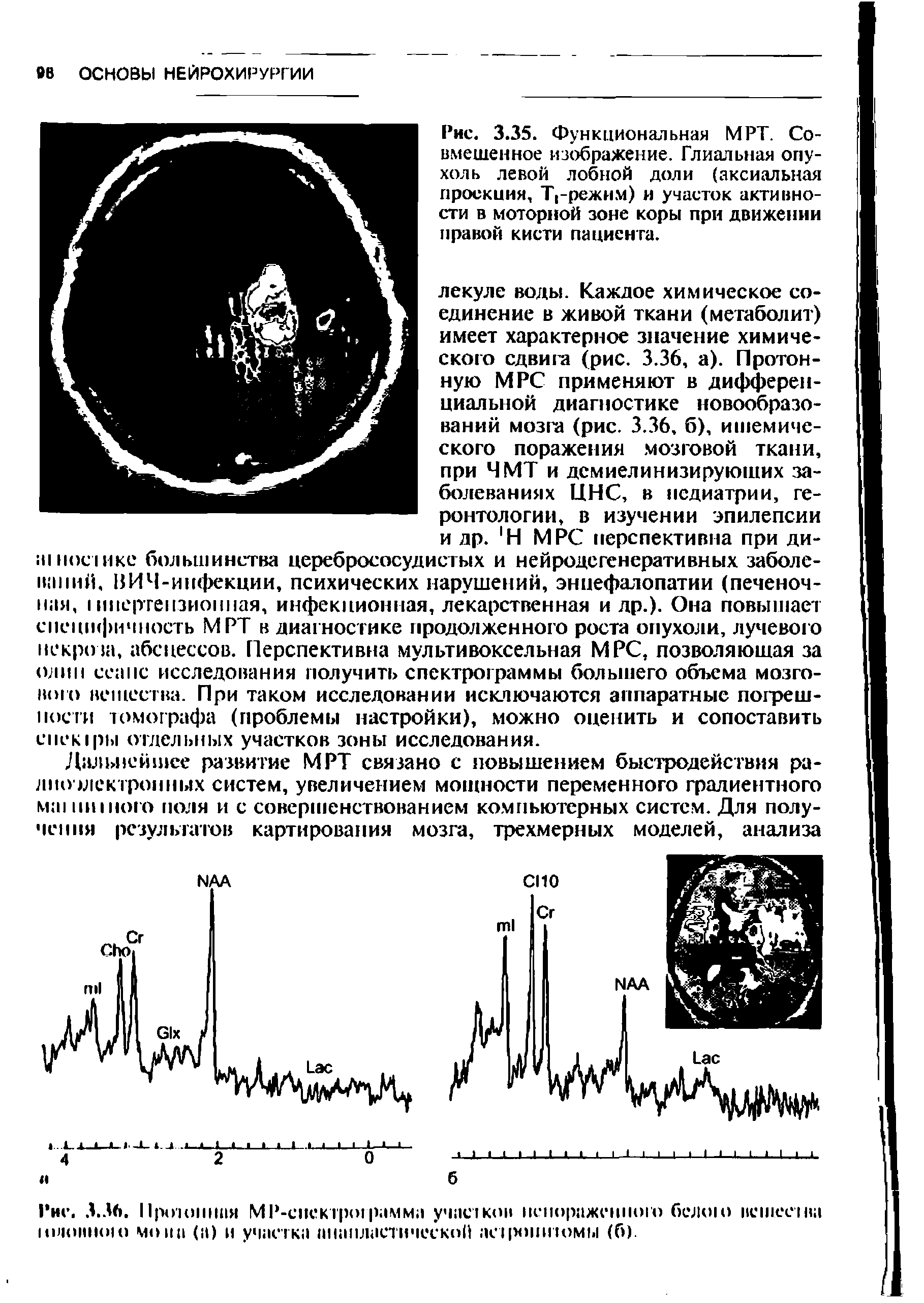 Рис. 3.35. Функциональная МРТ. Совмещенное изображение. Глиальная опухоль левой лобной доли (аксиальная проекция, Т -режим) и участок активности в моторной зоне коры при движении правой кисти пациента.